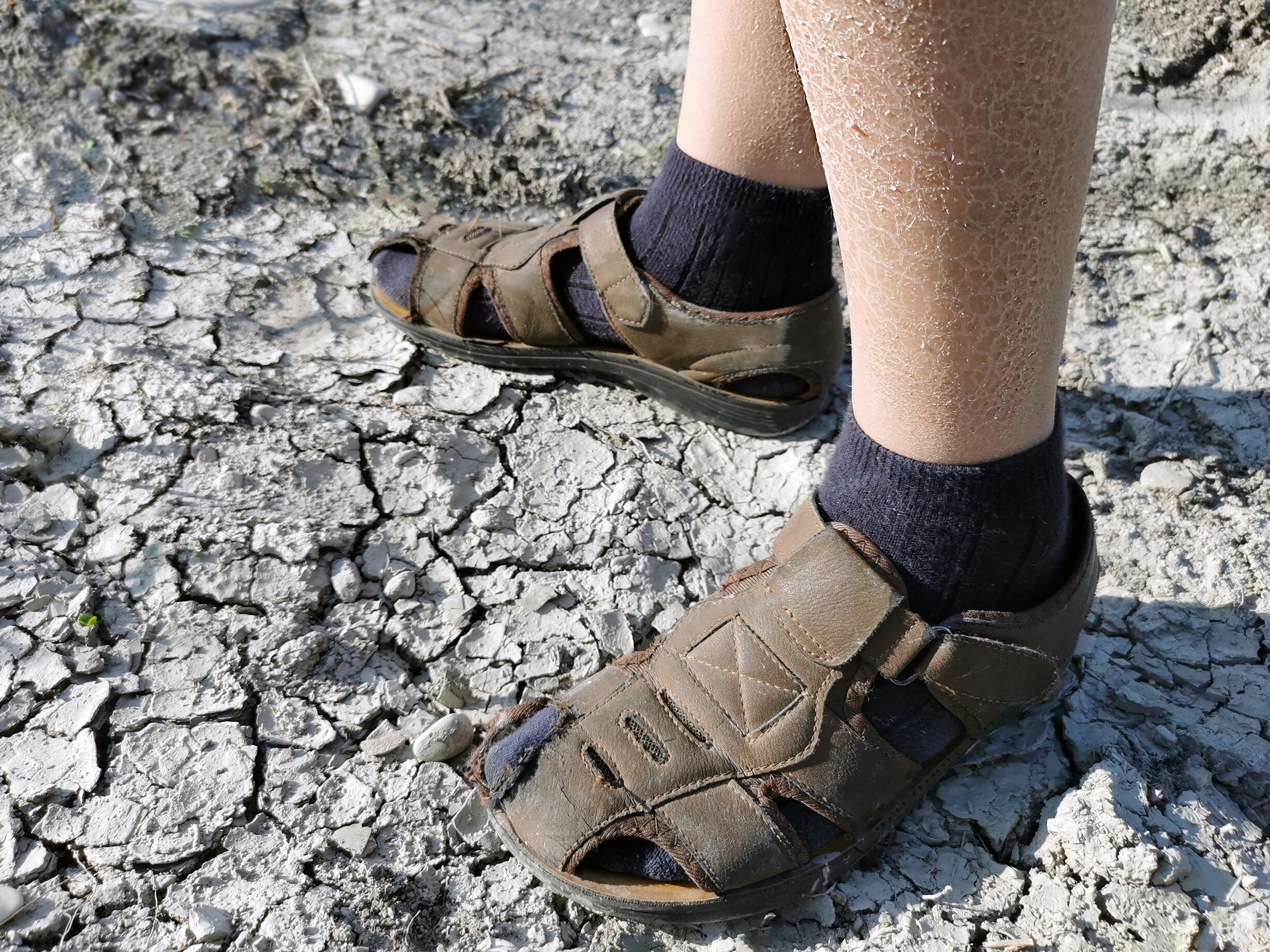 md_dexeryl_website-ichthyosis-image_adobestock_436851516