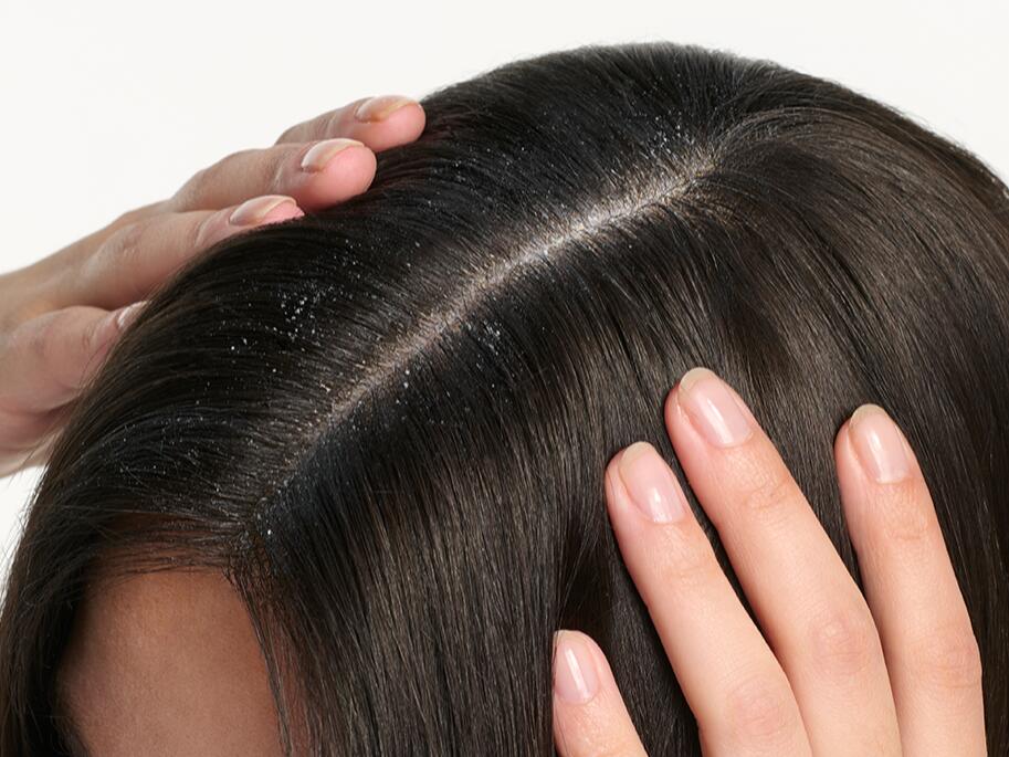 Vous avez des pellicules grasses ou sèches, des rougeurs ou des démangeaisons ?