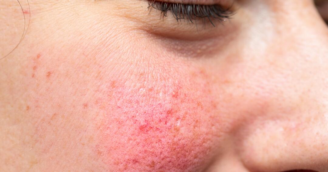 Lenire gli arrossamenti del viso dovuti alla couperose