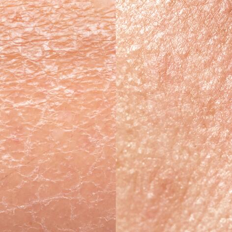 Dry skin or dehydrated skin?