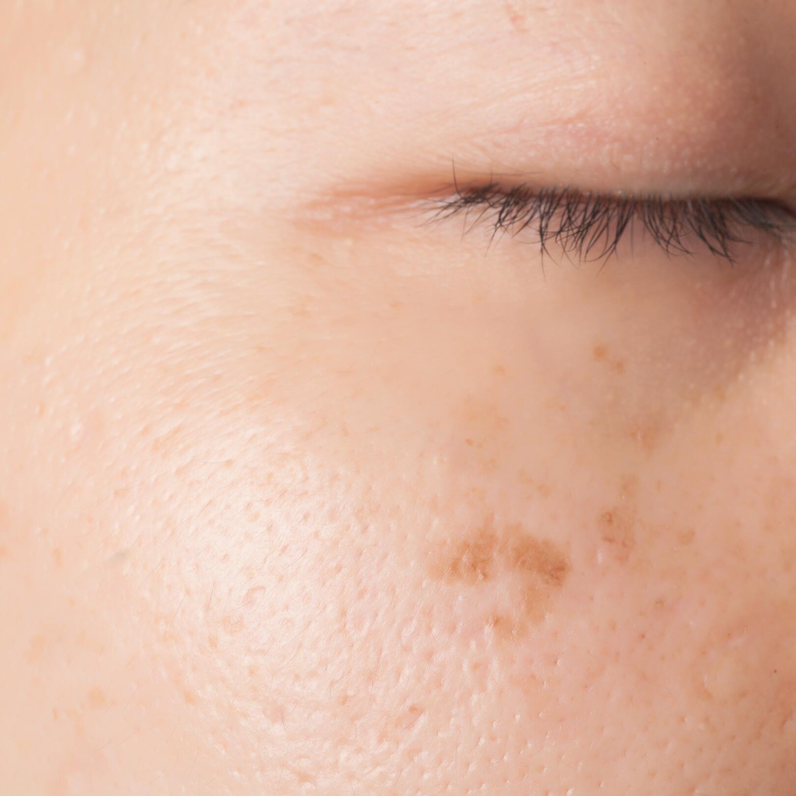 av_peau-cancer_hyperpigmentation_1x1