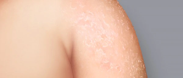 du_dexyane-med_silo_eczema_symptoms_l3_header_dry-skin