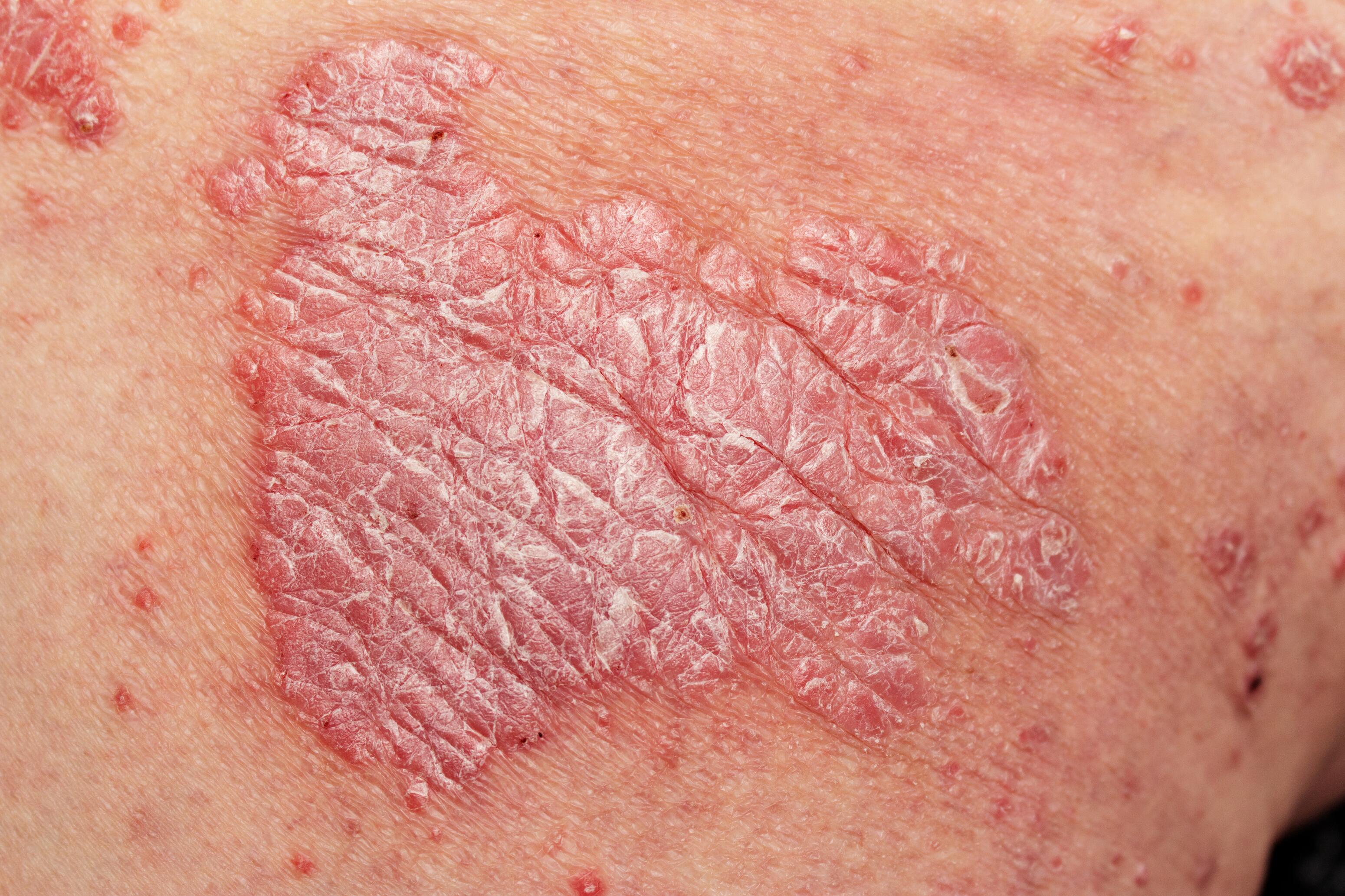 Les plaques de psoriasis Ducray