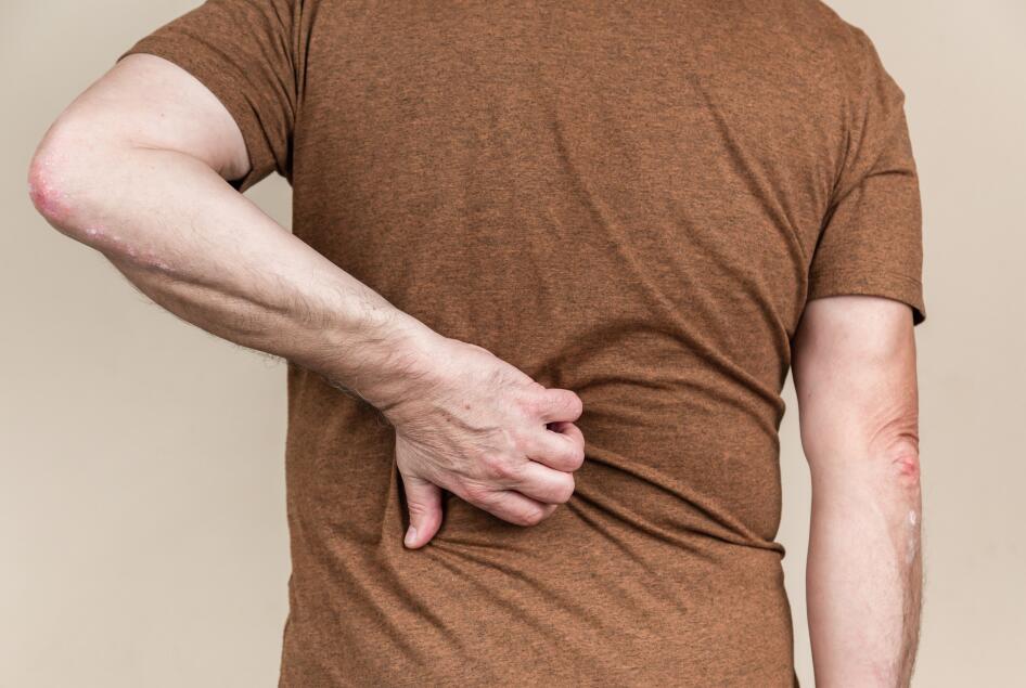 Le psoriasis du dos et des fesses | Ducray