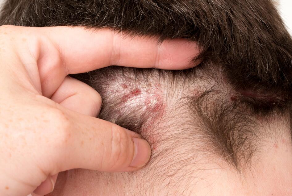 Psoriasis et dermite séborrhéique : comment savoir ? | Ducray