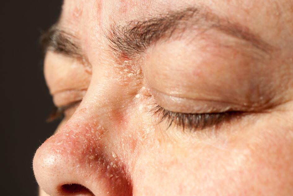 Psoriasis visage : comment le reconnaître et le soigner ...