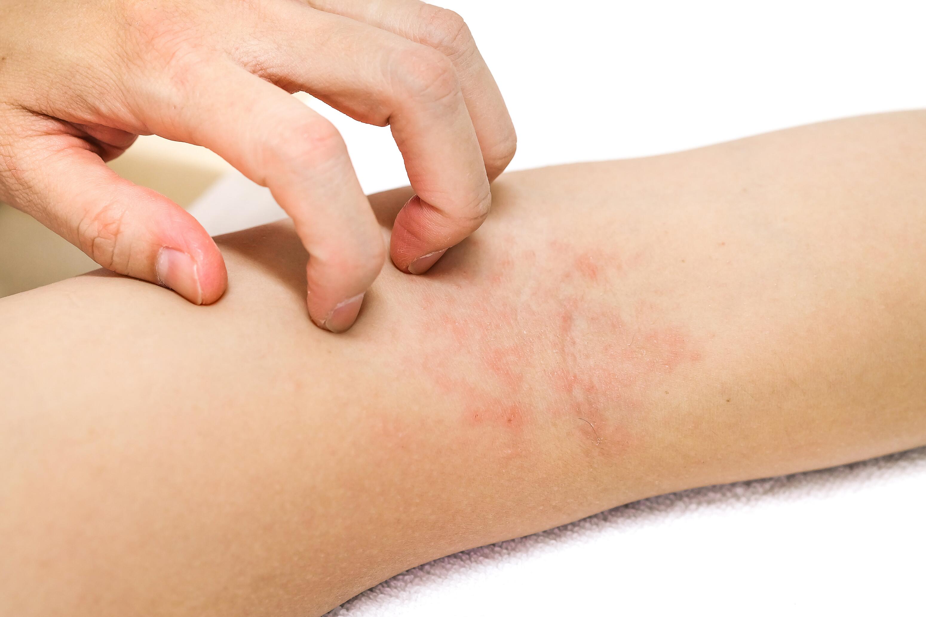 DU_KERTYLOL-PSO_SILO_PSORIASIS_SYMPTOMS_L3_eczema