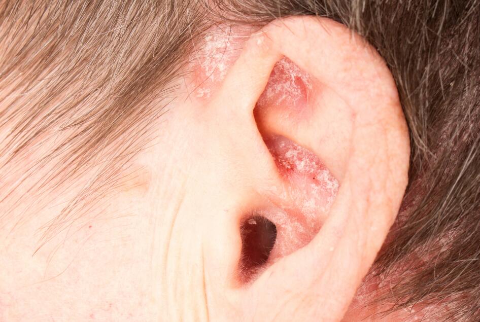 Le psoriasis de l'oreille | Ducray