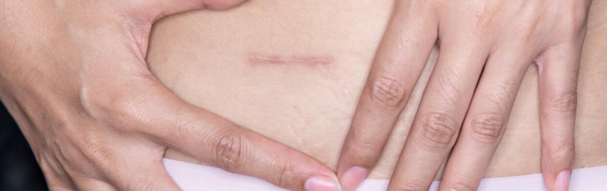 AD_EPITHELIALE_RED-SCAR_SILO_L1_HEADER