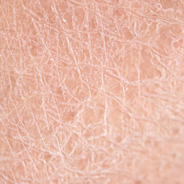 AV_peau-tres-seche_1x1