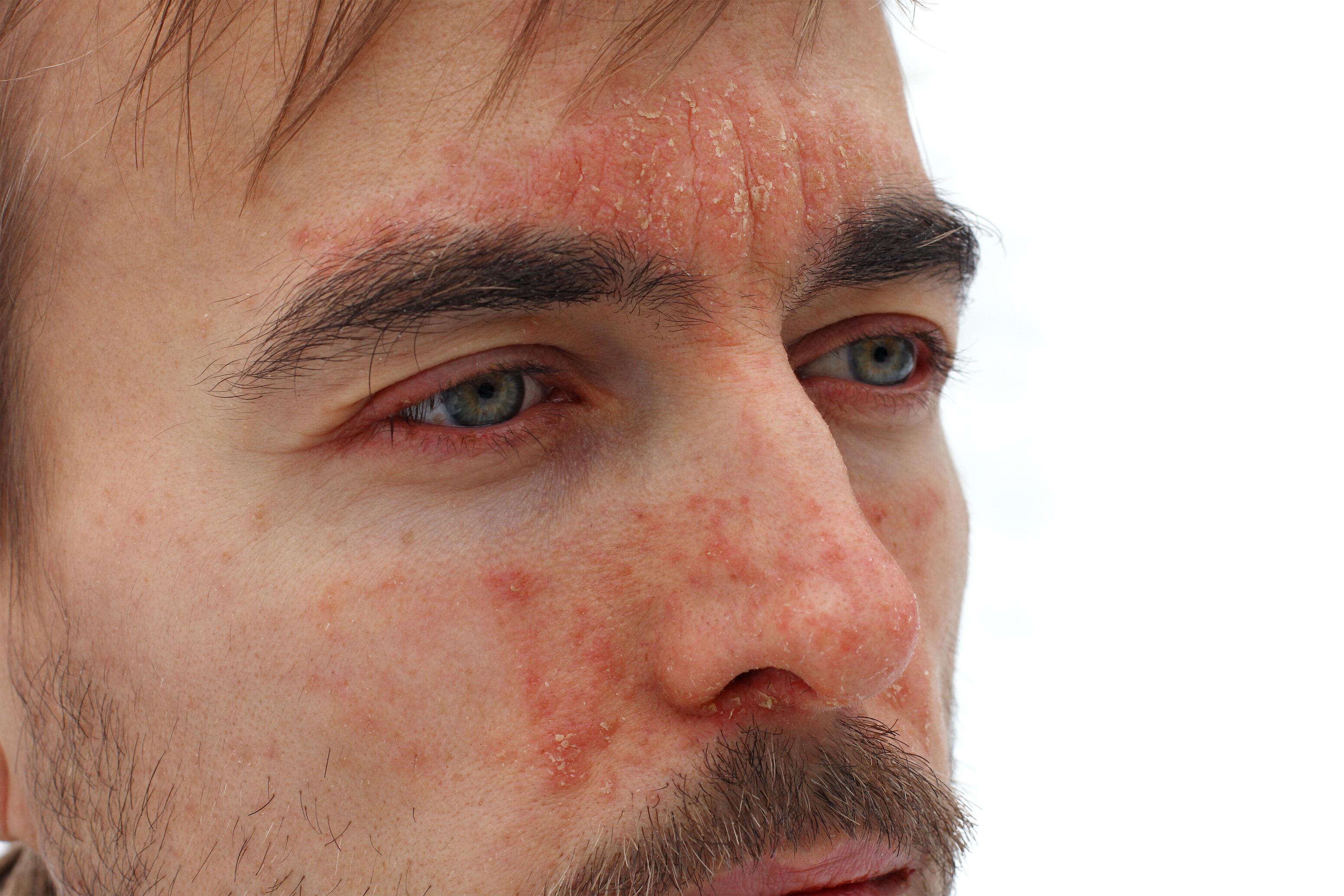 
    Psoriasis


