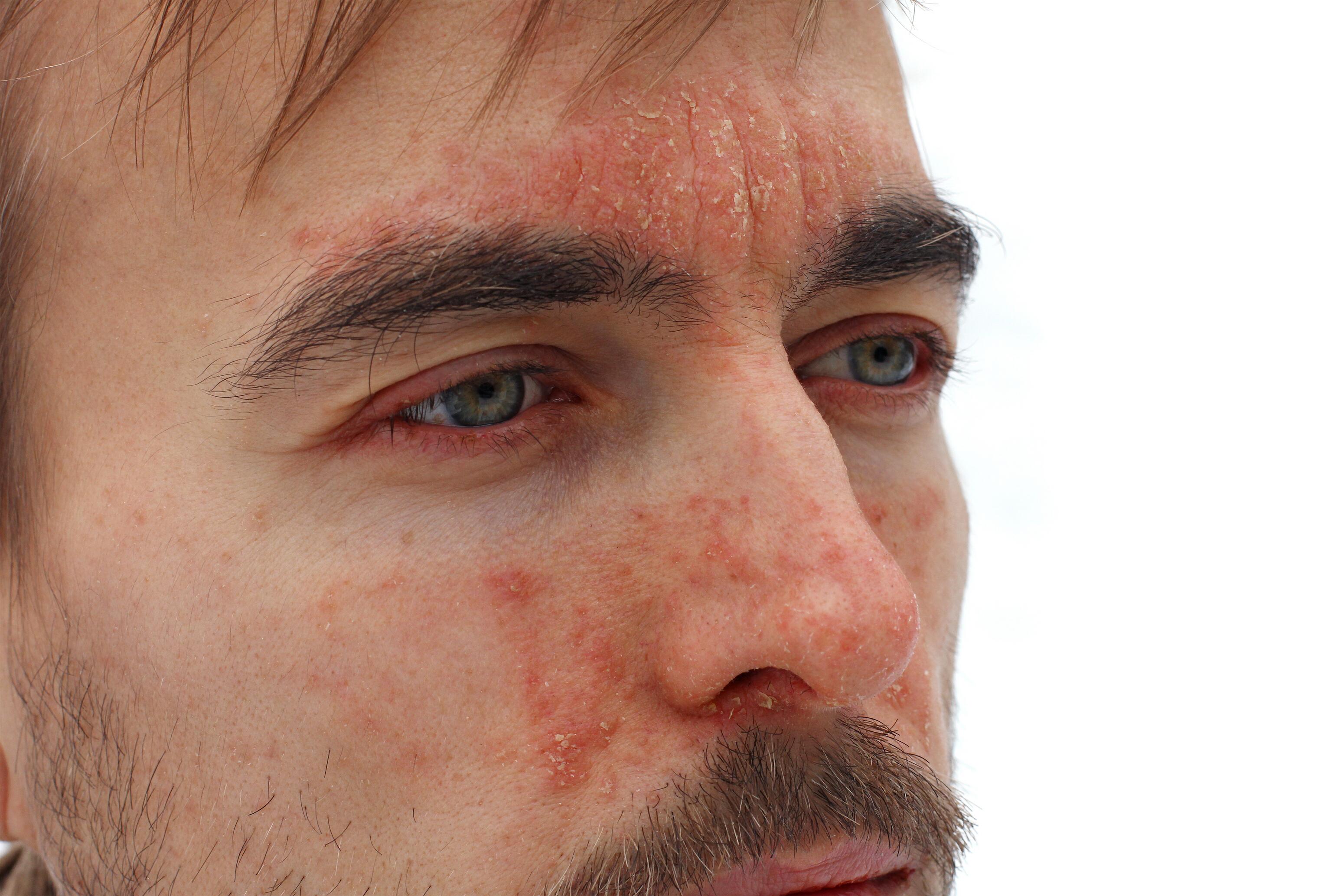 Homme avec du psoriasis sur le visage