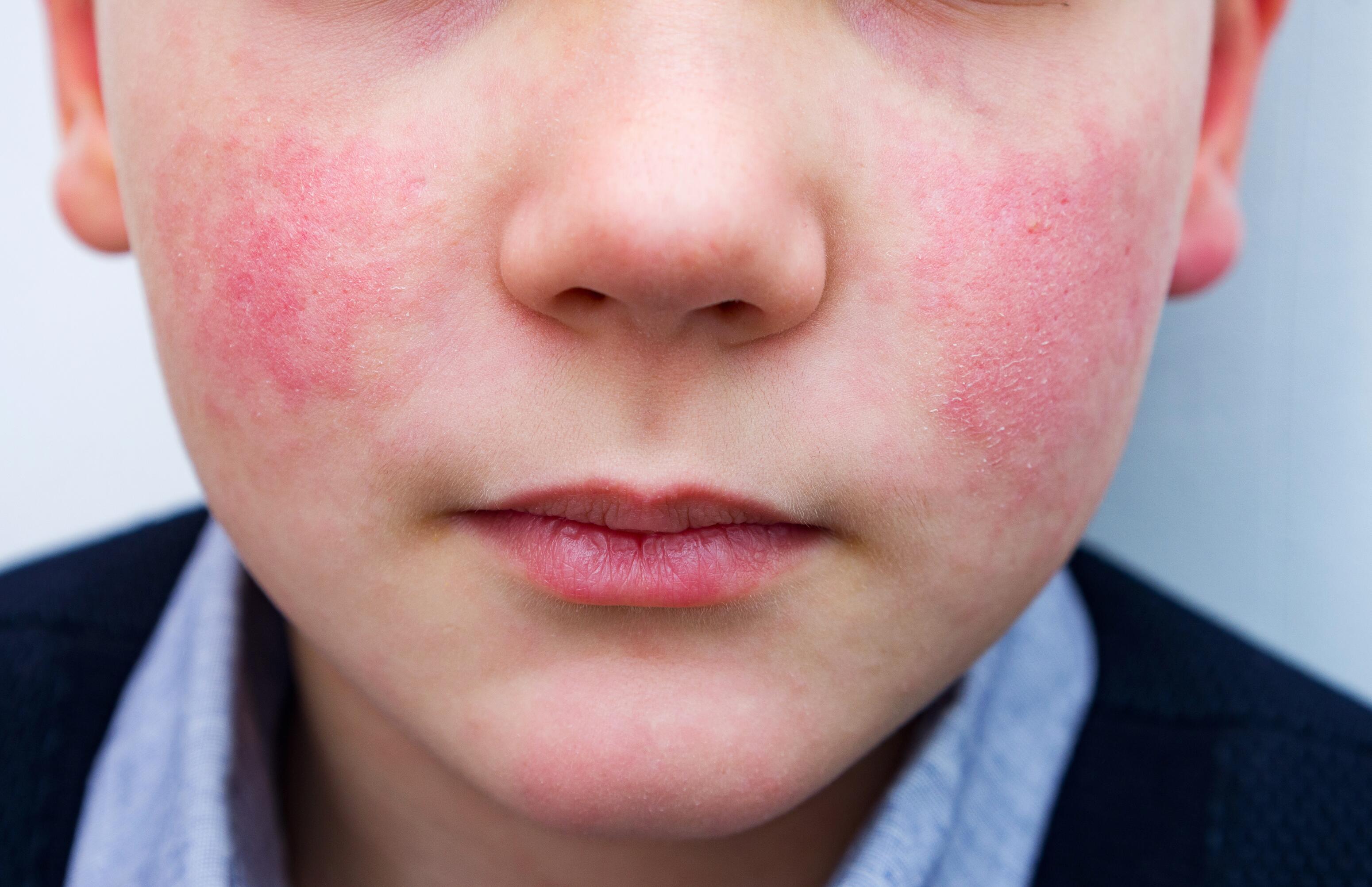 Enfant avec du psoriasis sur le visage