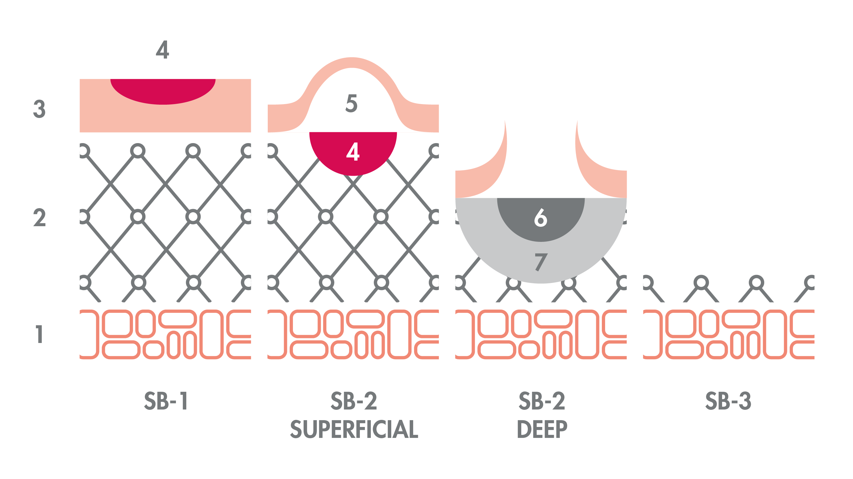 av_solaires_schema_brulure_degres-1-2-2-3_16x9