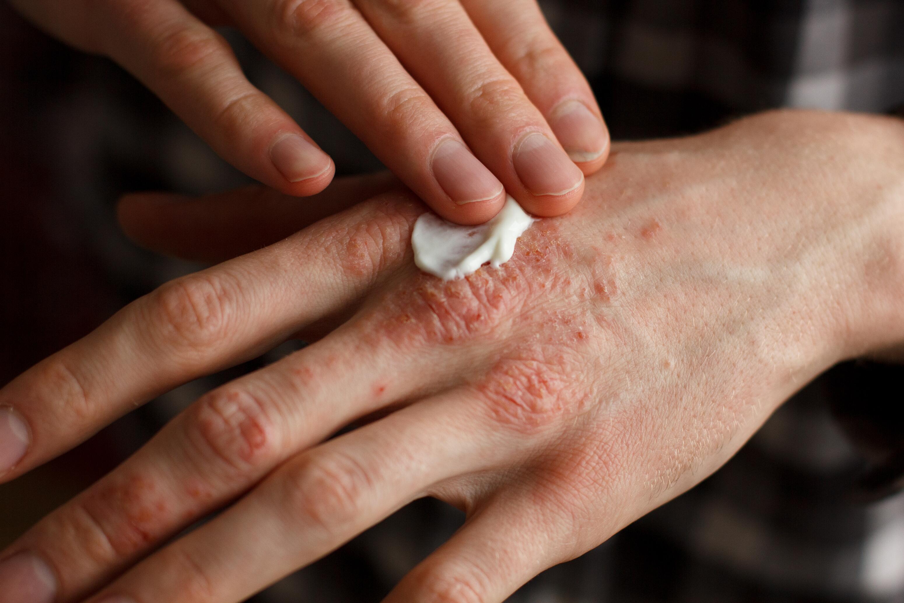 eczema-mano-crema-emoliente-dexeryl