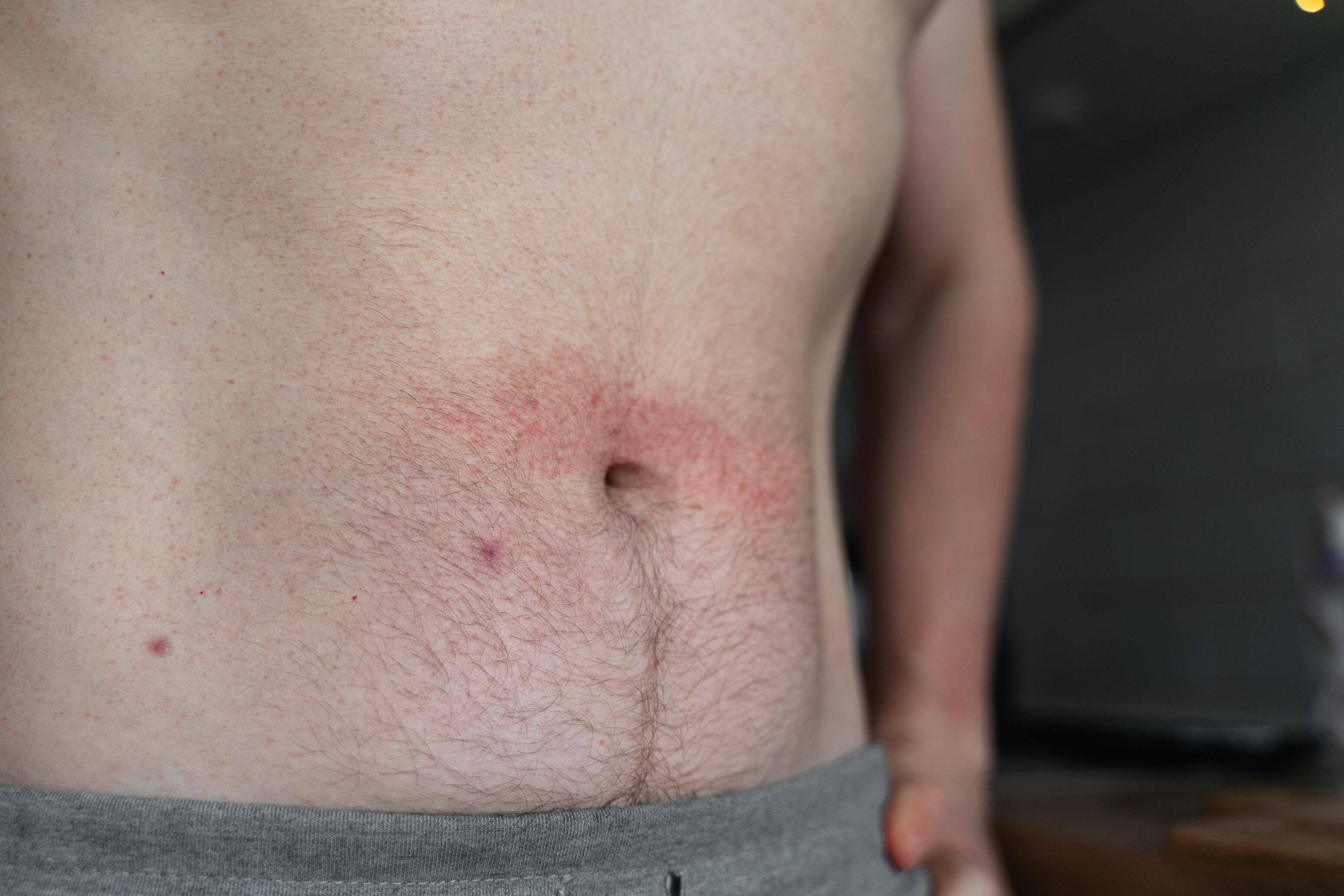 Las causas del eczema: ¿por qué se produce el eczema y cómo puede prevenirse?