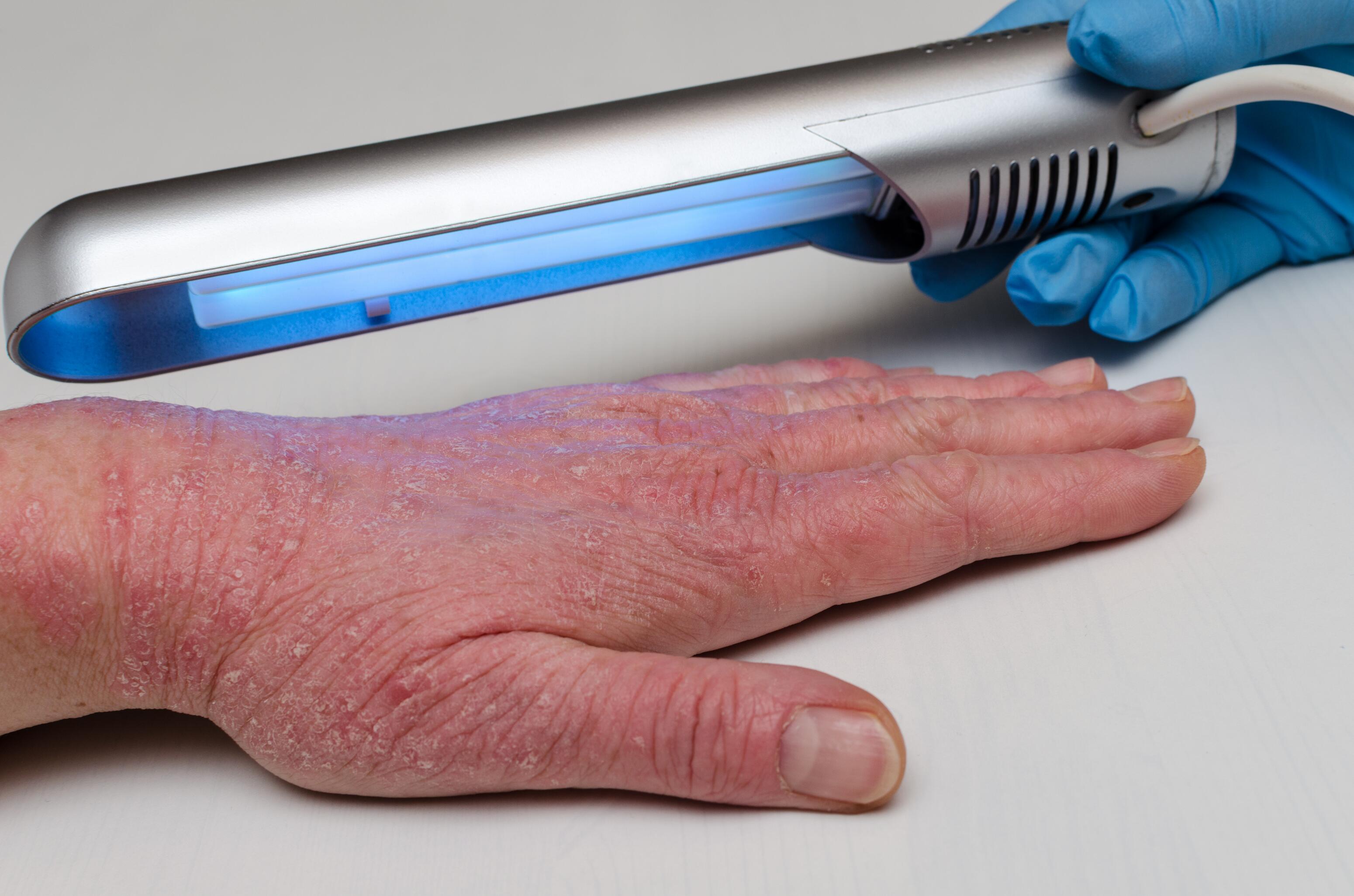 Hand eczema treated with phototherapy