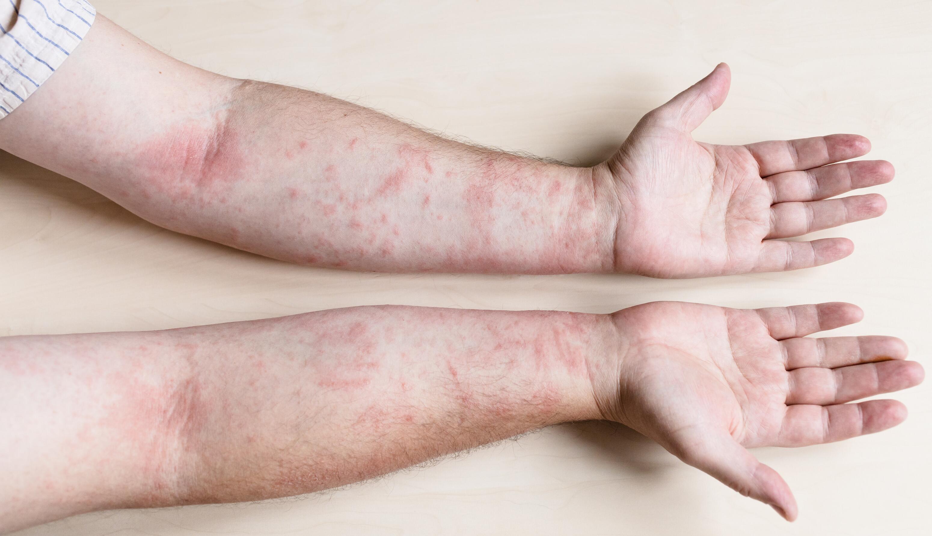 People with eczema on their forearms