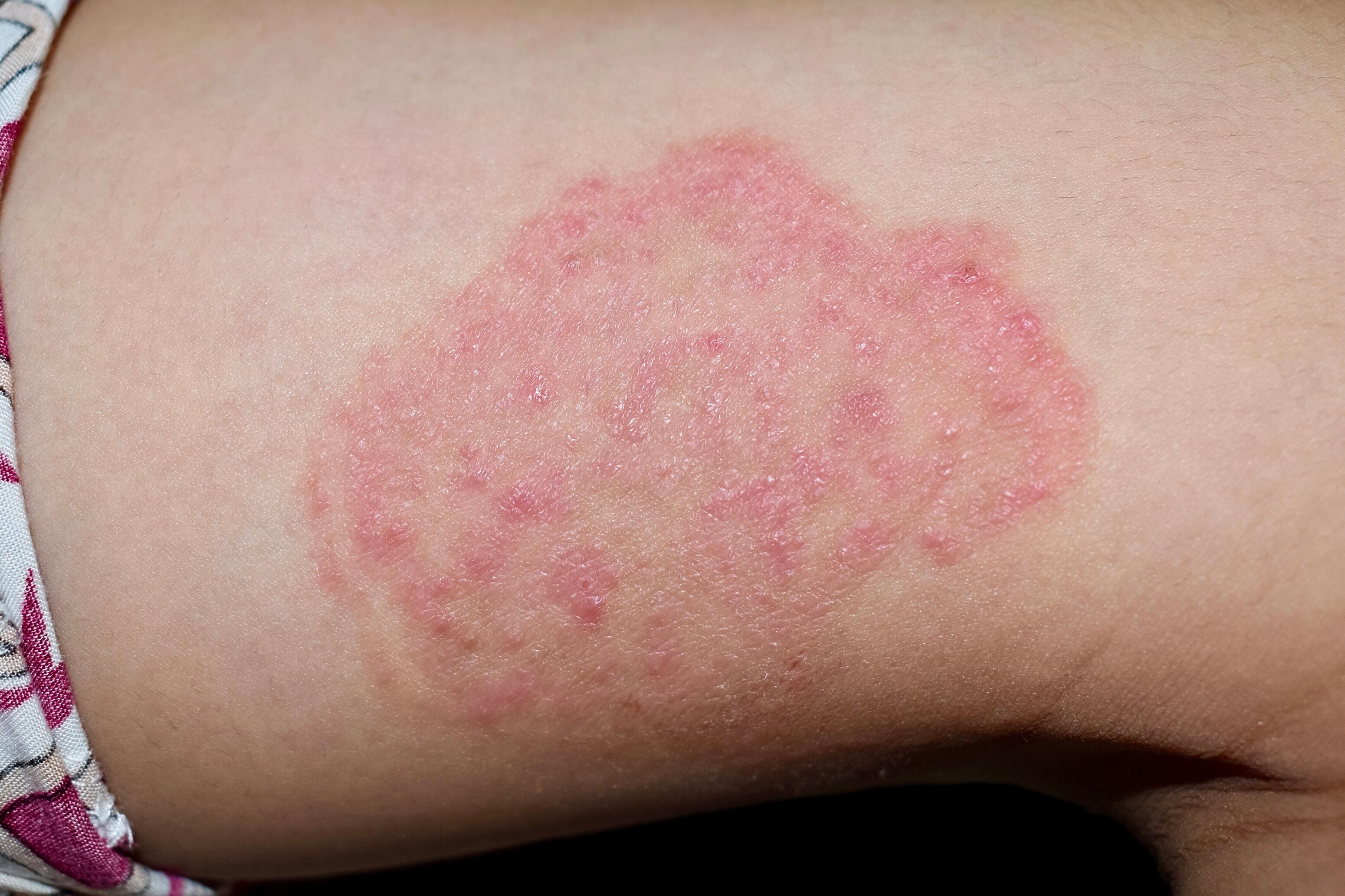 Skin with rounded lesions of nummular eczema