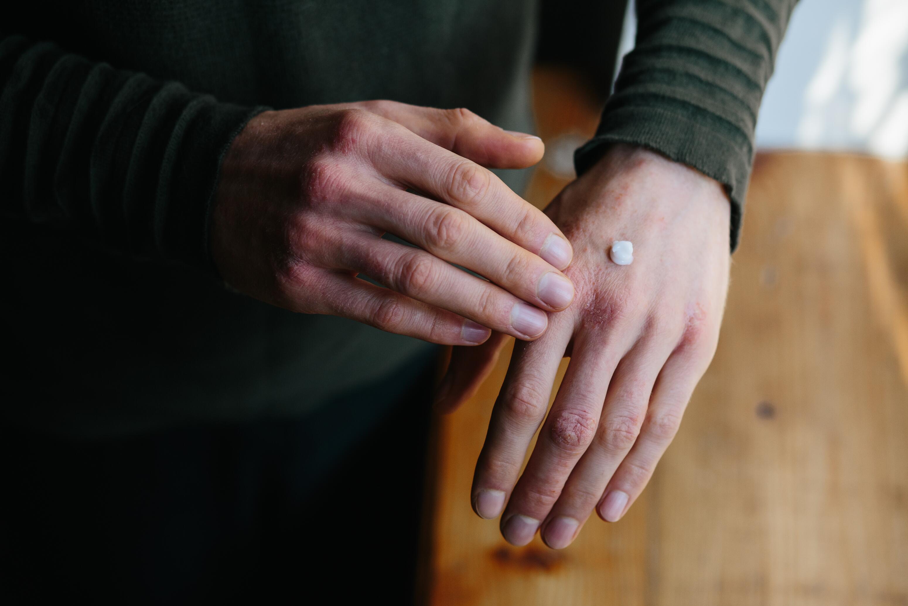 eczema-hydration-dry-skin-emollient