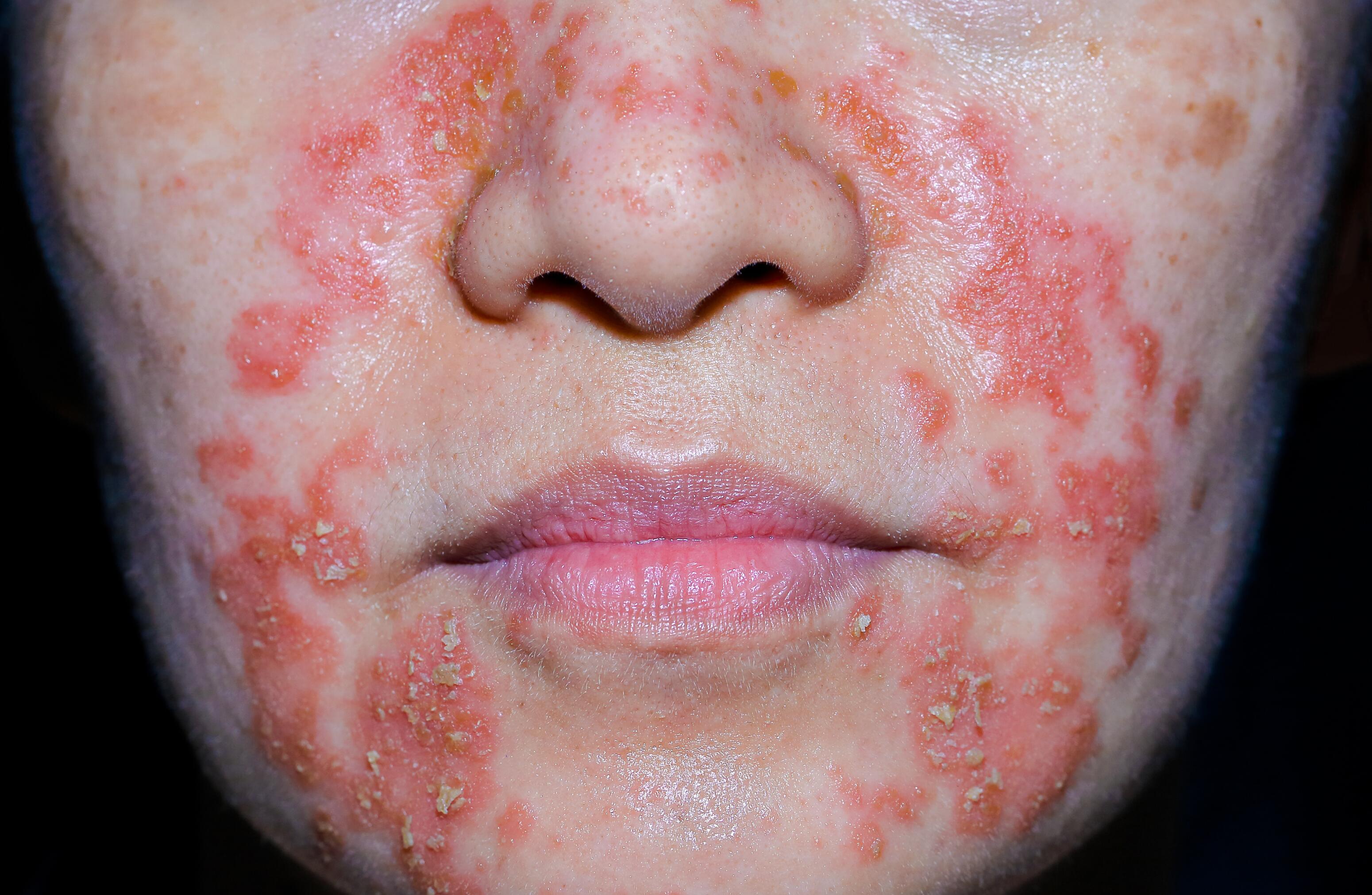 Woman with scales on her face due to seborrhoeic dermatitis