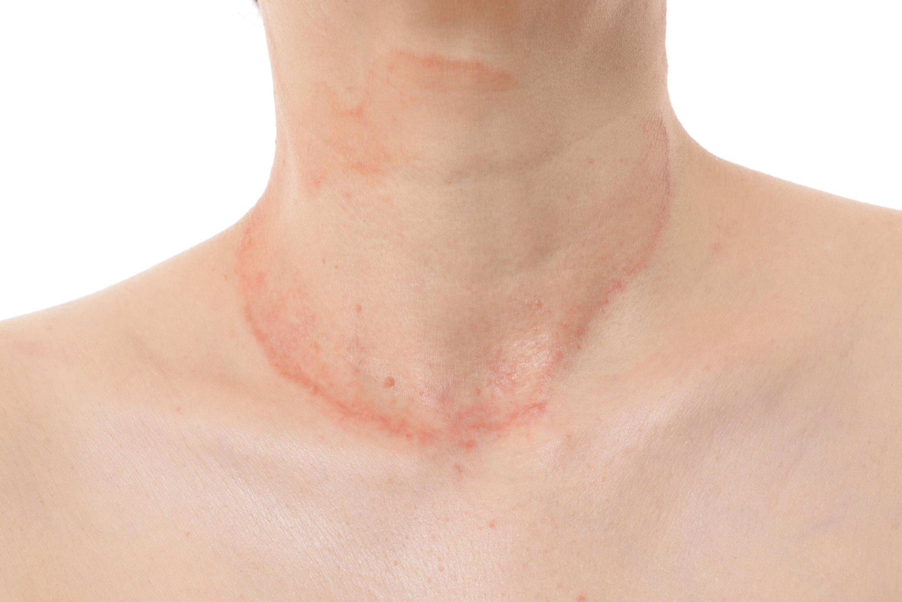 People with contact eczema around the neck caused by an allergy or irritant