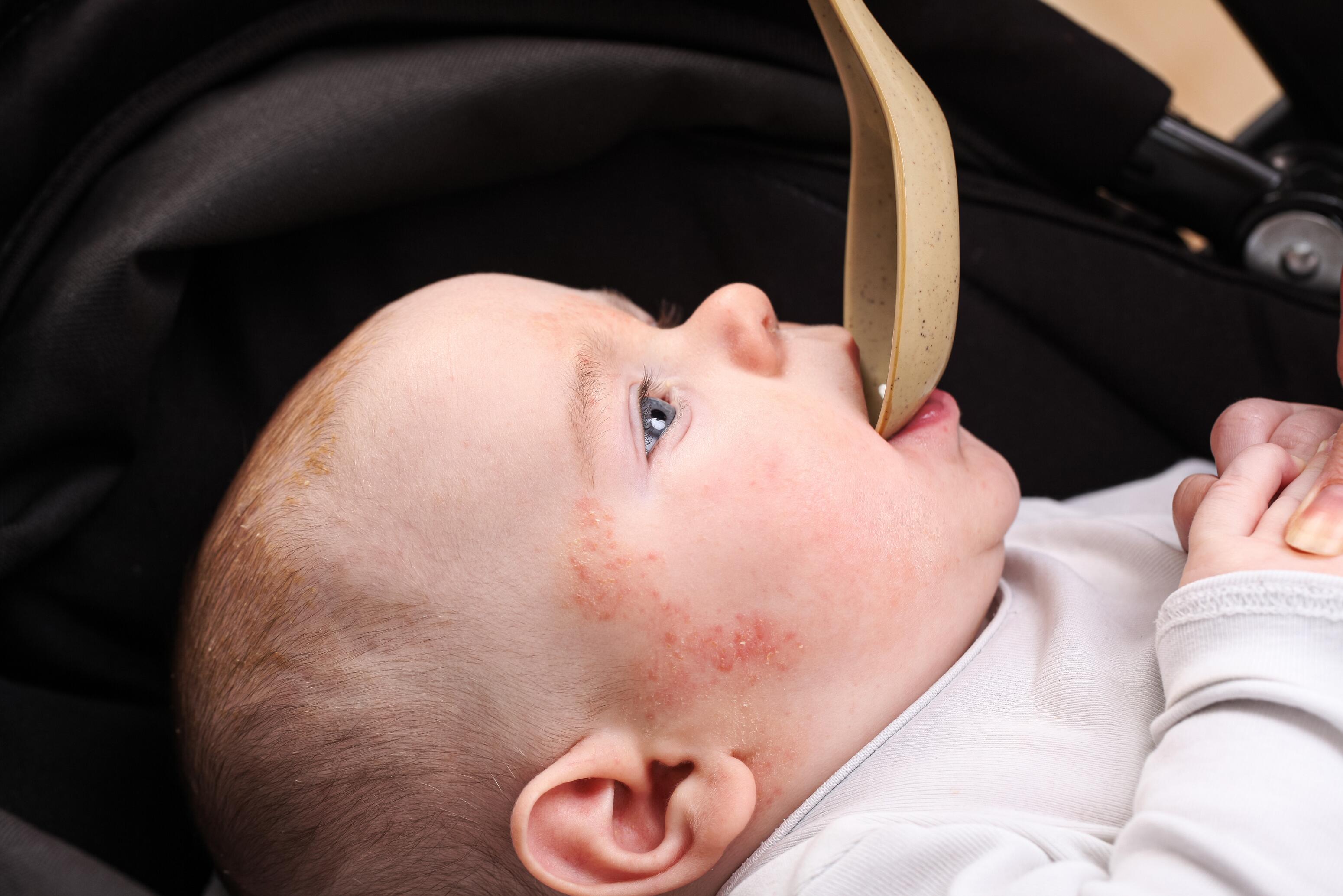 Mother spoon-feeding medicine to a baby with atopic dermatitis on the face