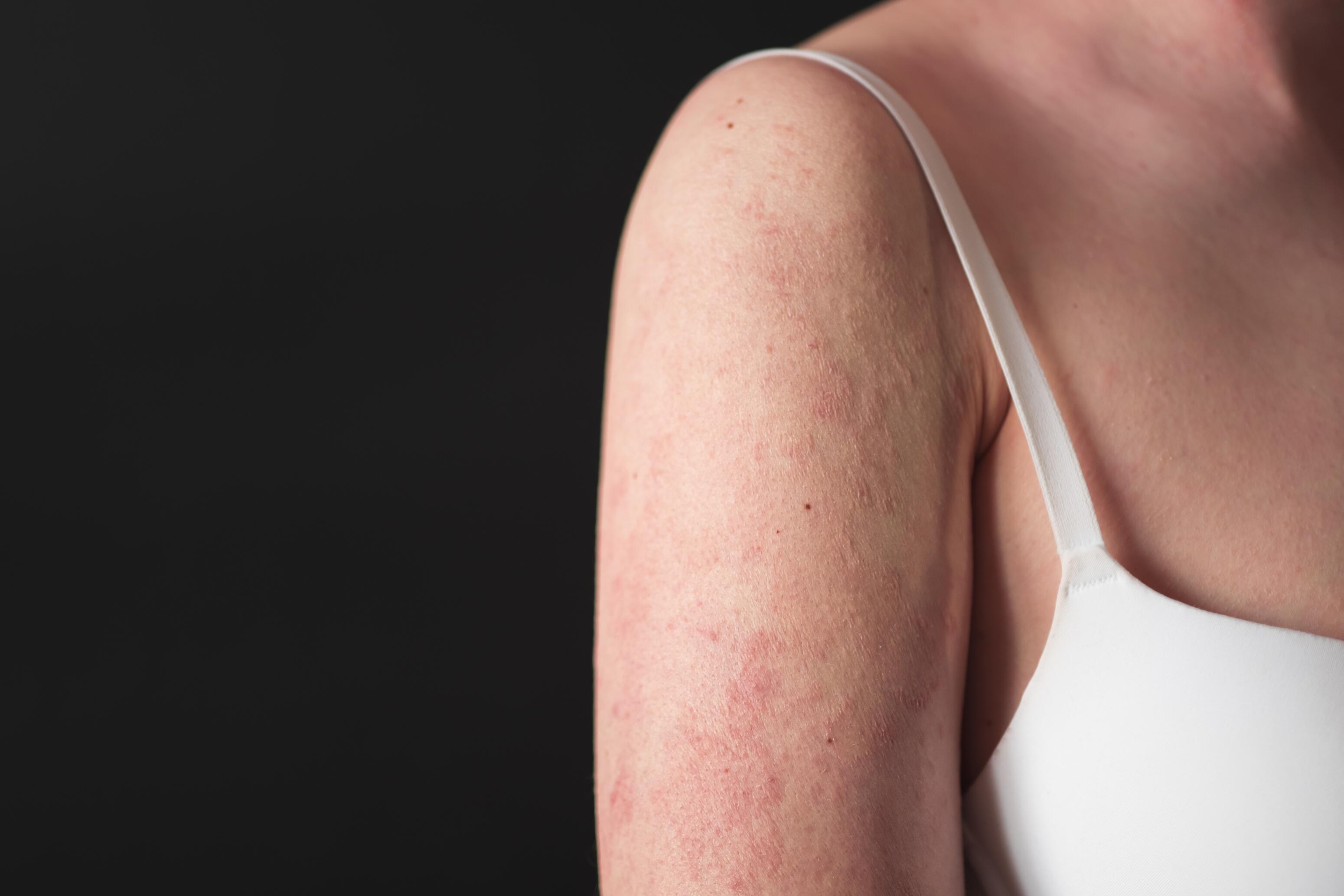 Woman with eczema on her arm and shoulder