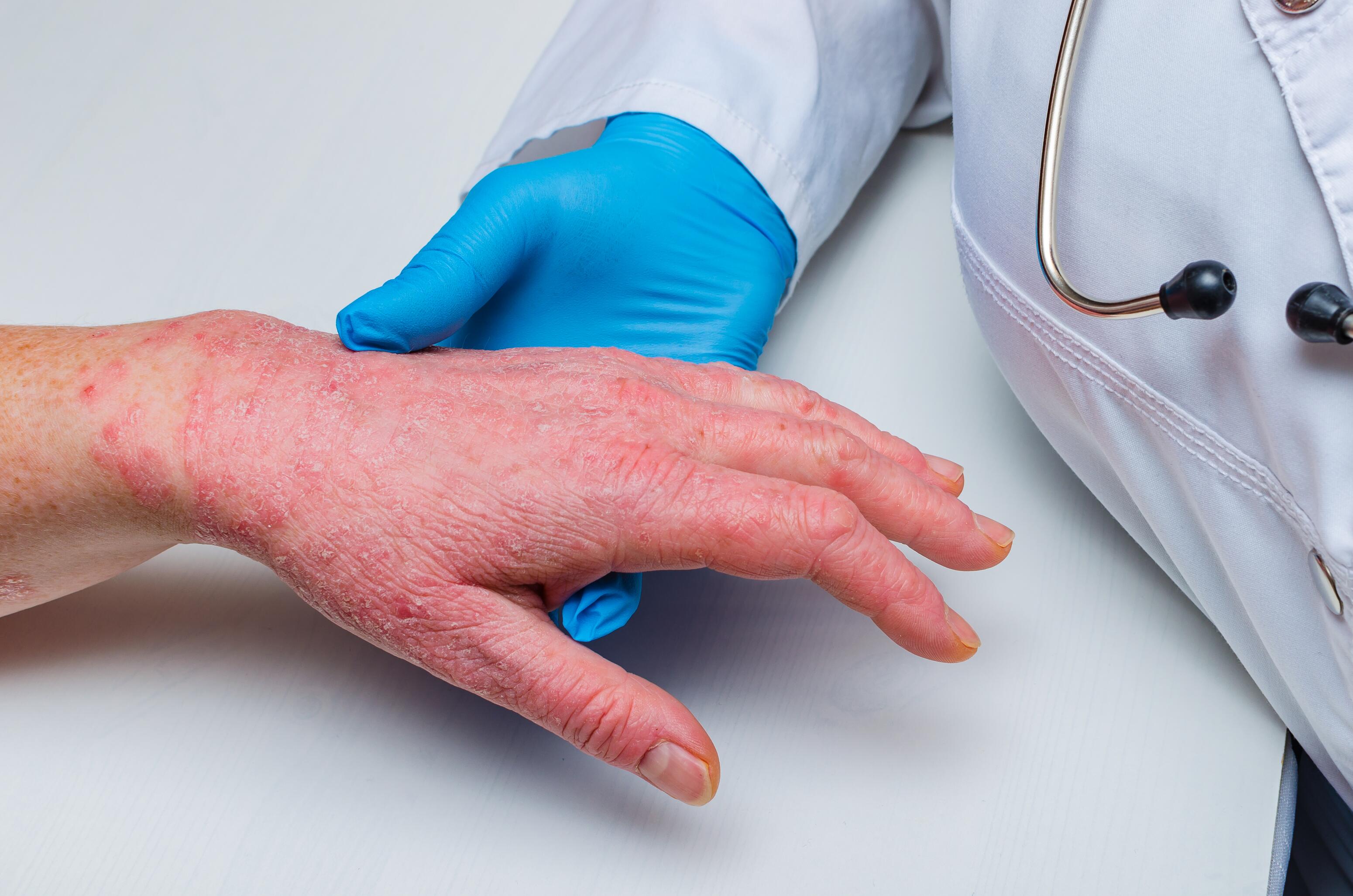 Doctor holding the hand of a person with chronic hand eczema