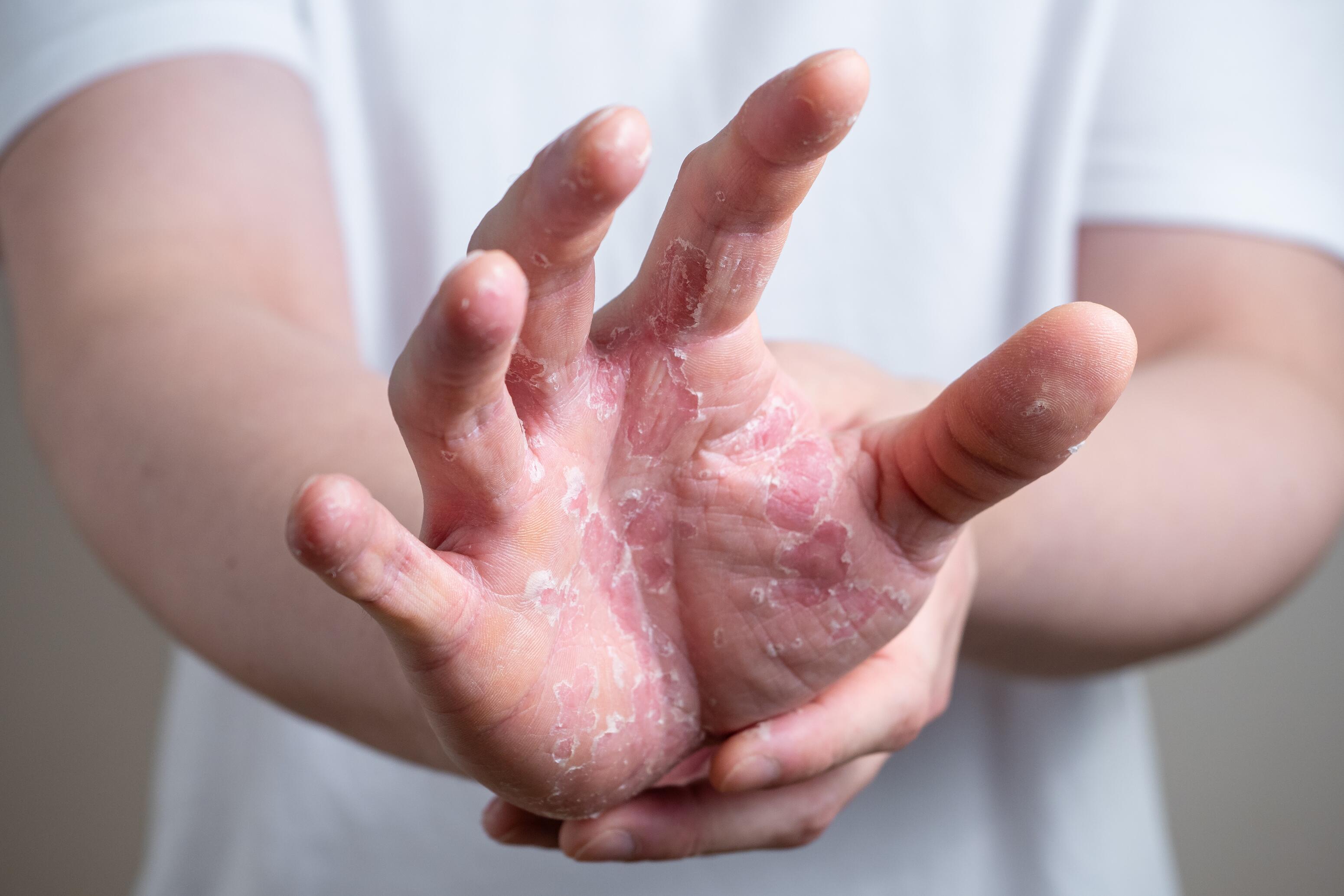 Hand with dyshidrosis on fingers and palm