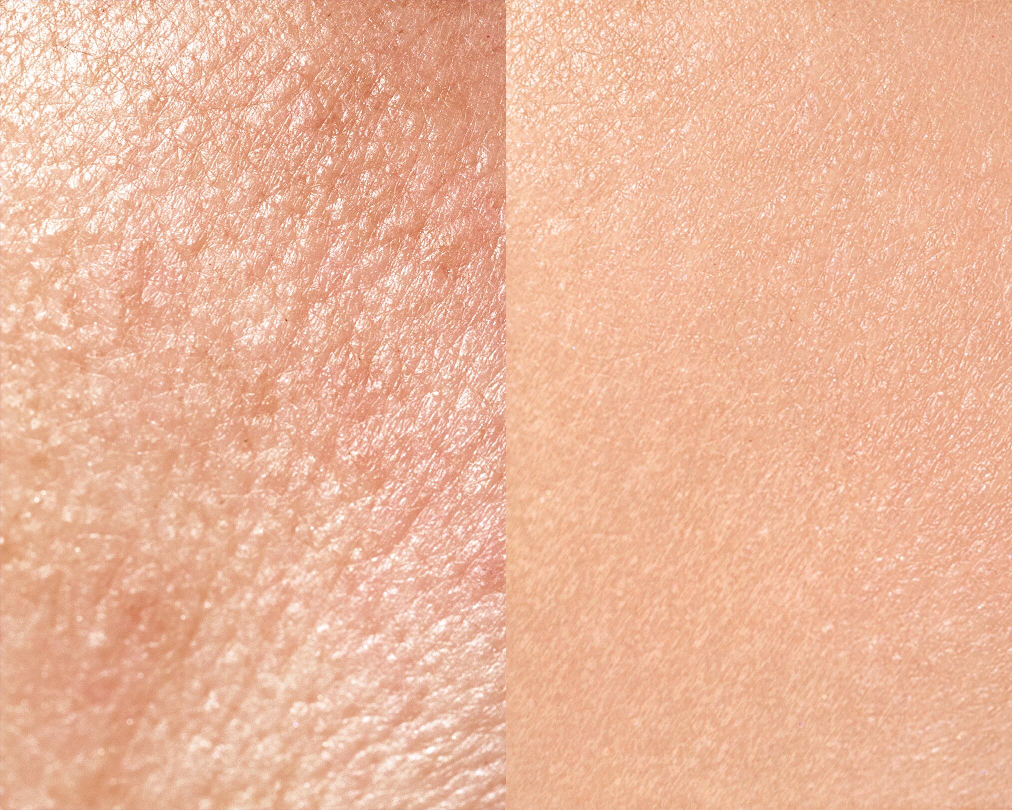 av_peau-seche-deshydratee_zoom-peau-deshydratee_5x4