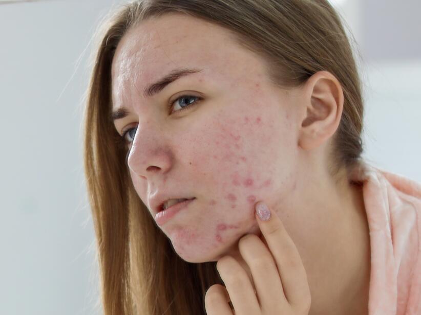 L'acné