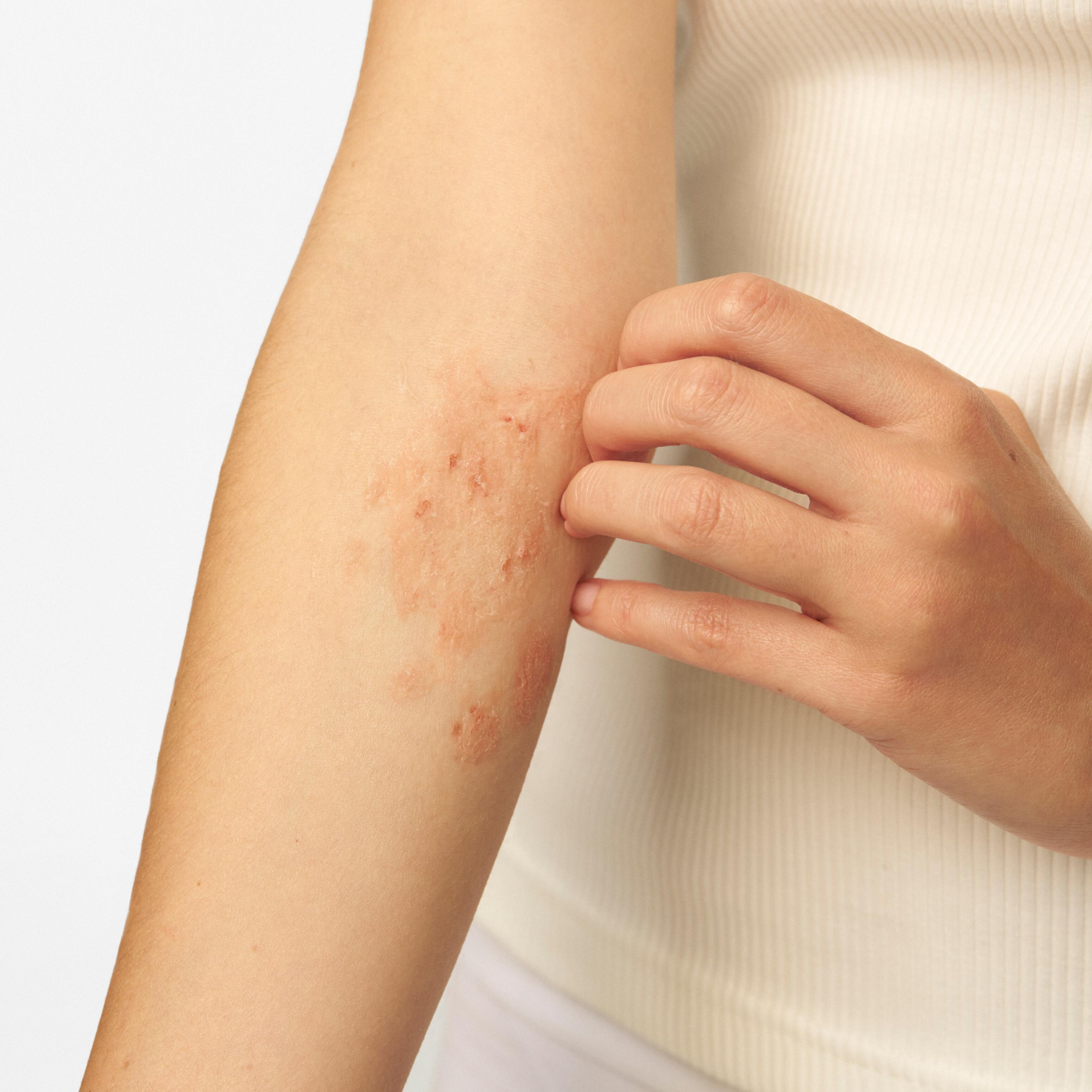 Peaux à tendance à l’eczéma atopique