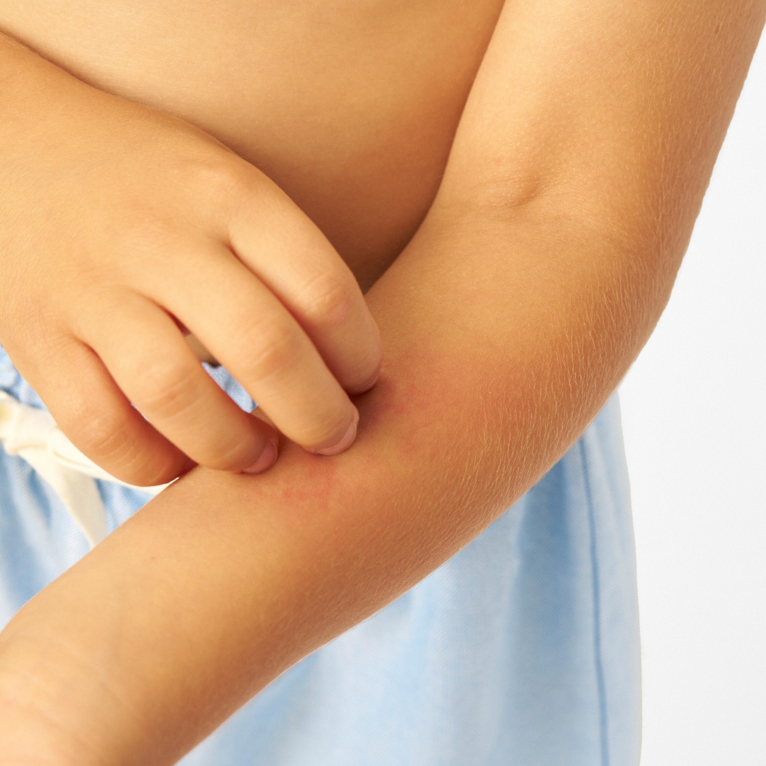 Peau irritée, sujette à macération