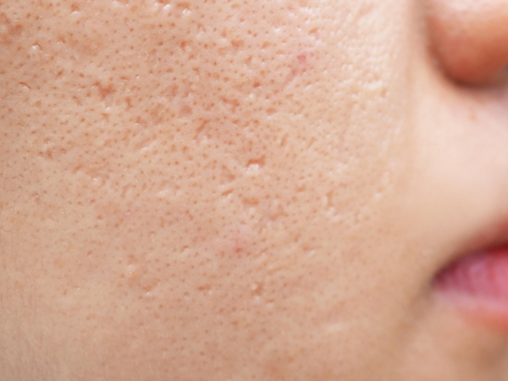 Cicatrices atrhophiques