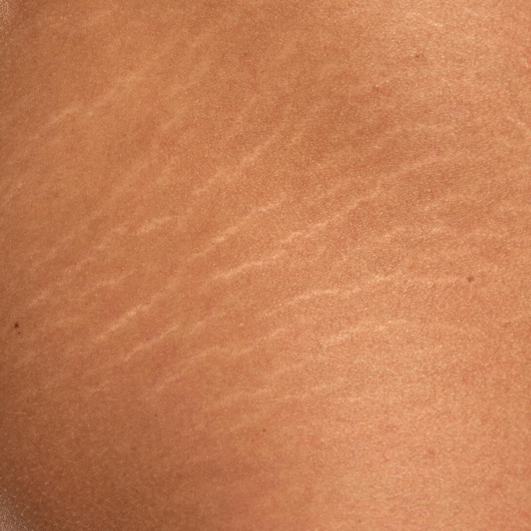 Cicatrices étirées