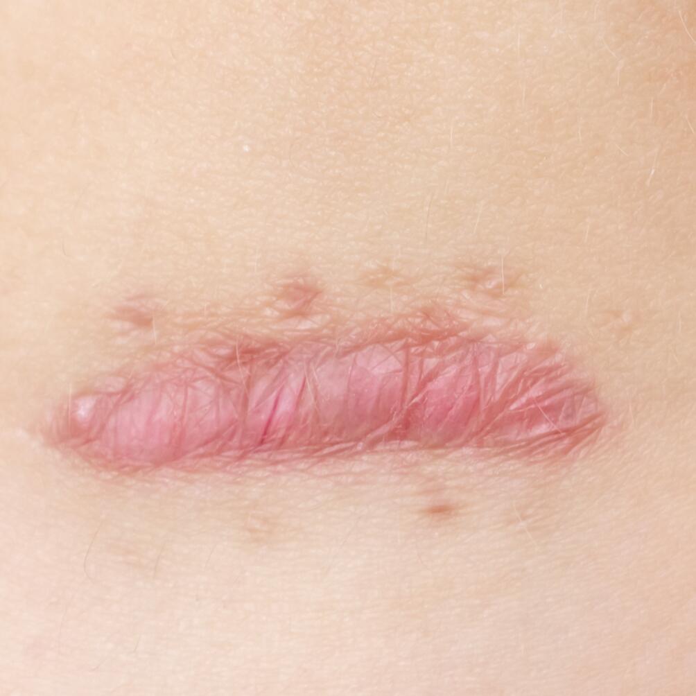 Cicatrices chéloïdes