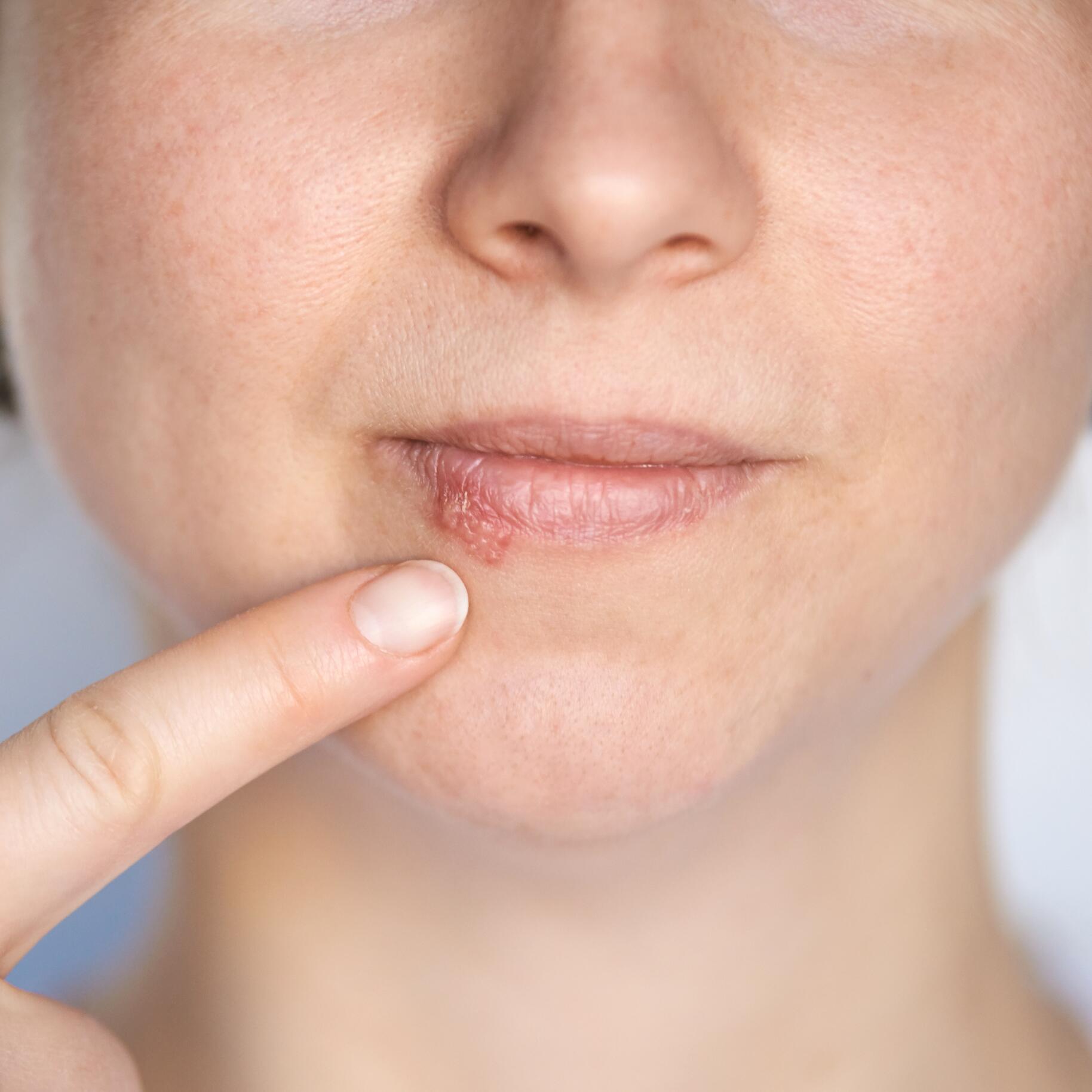 Des boutons autour de la bouche