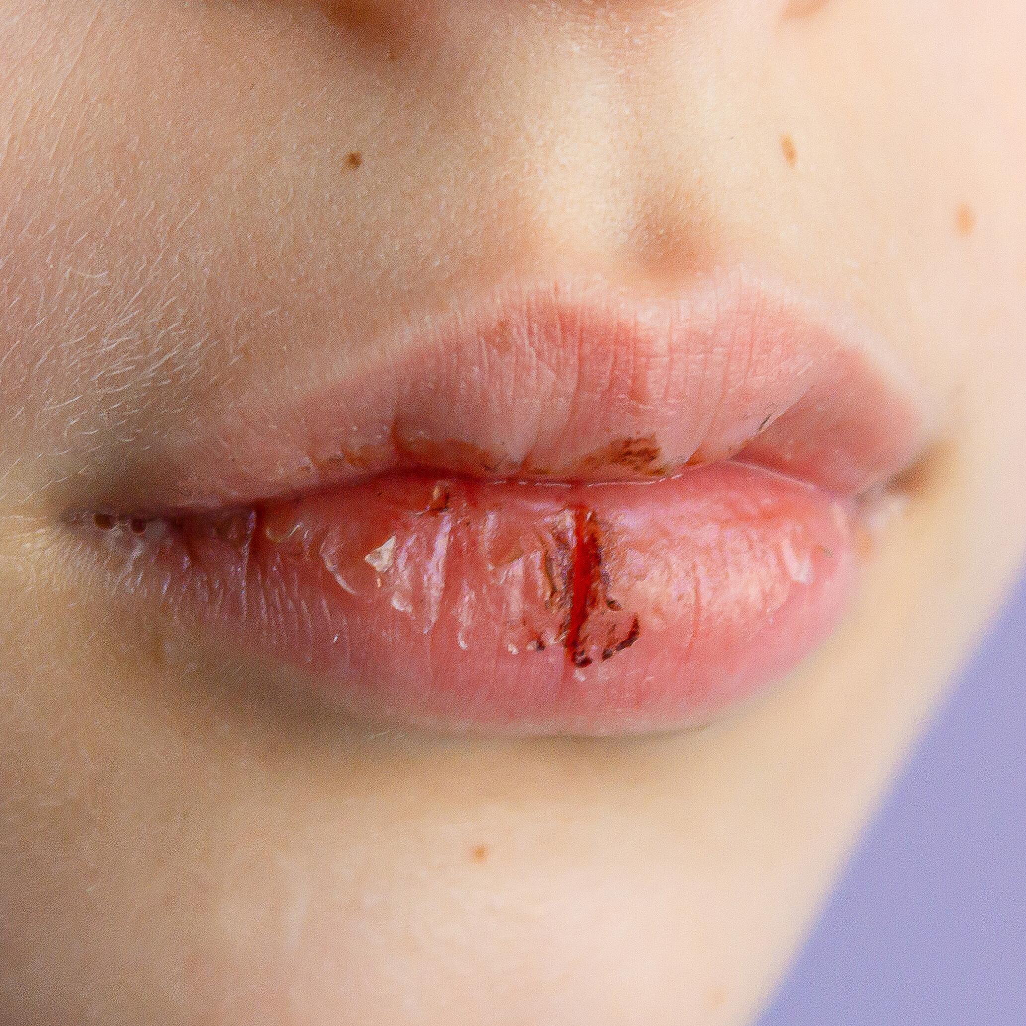 Une sècheresse autour de la bouche