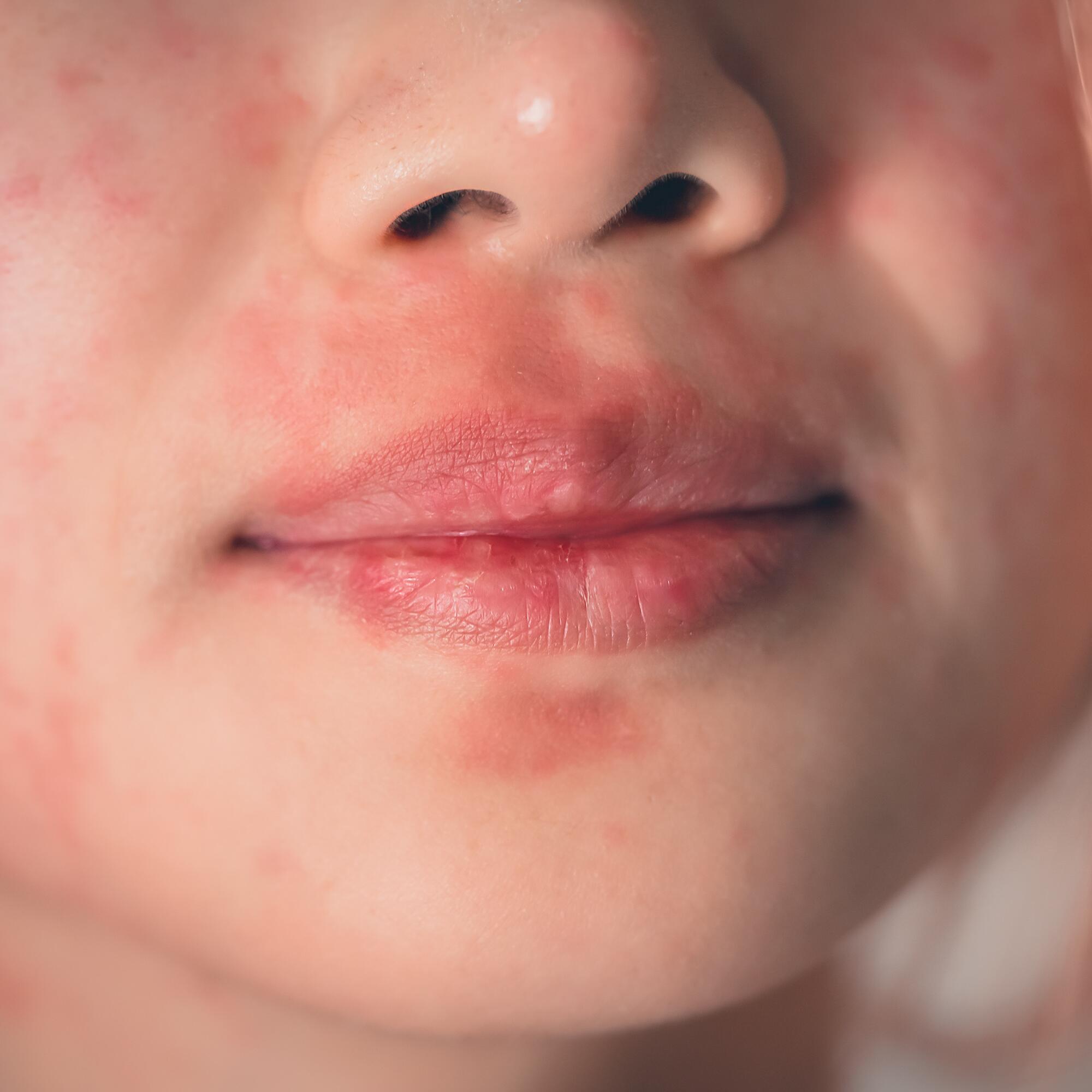 AD_DERMALIBOUR_SILO_IRRITATED-MOUTH_L3_REDNESS