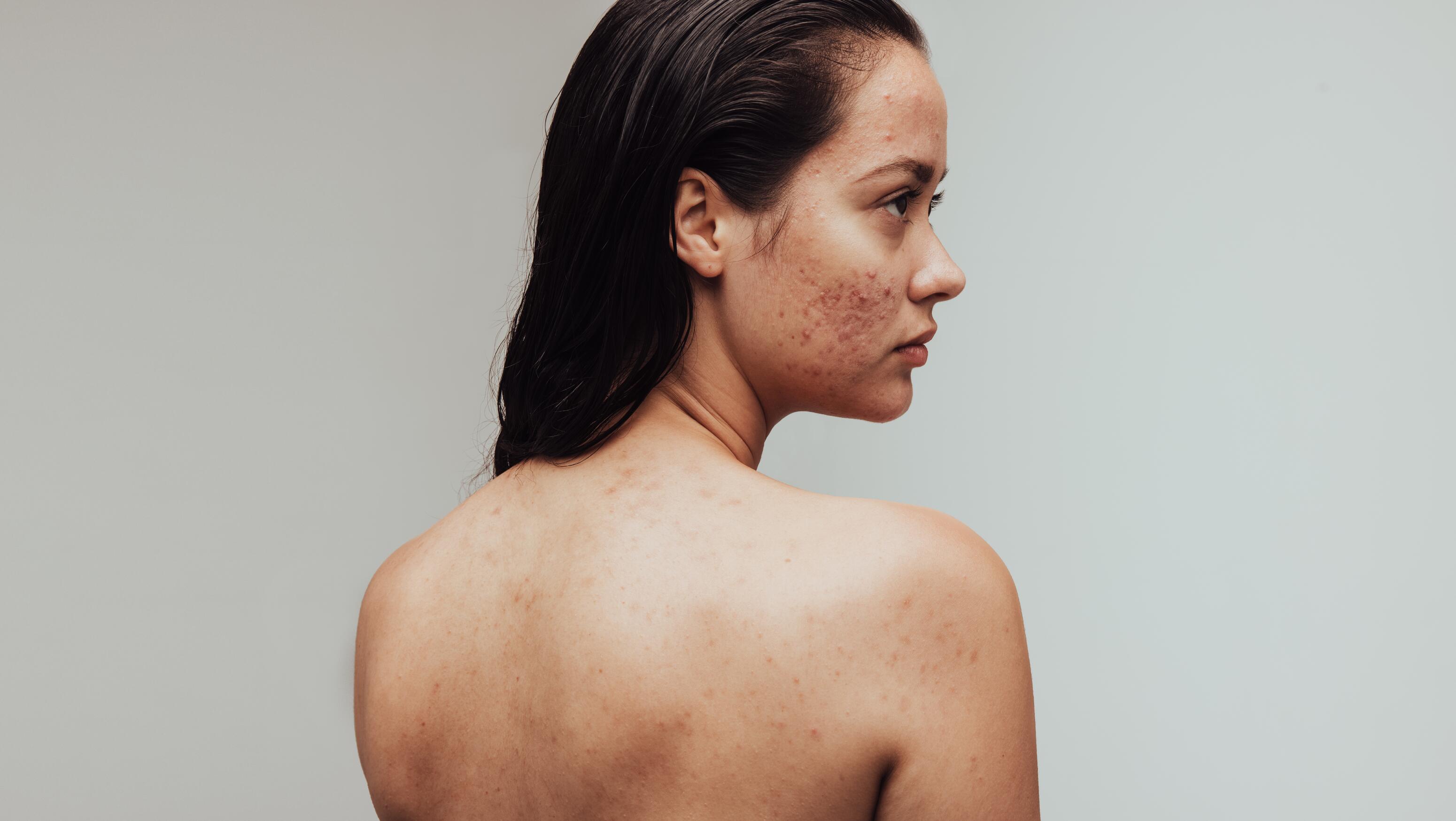 Body acne : Causes and effective treatments, image size:3100x1747