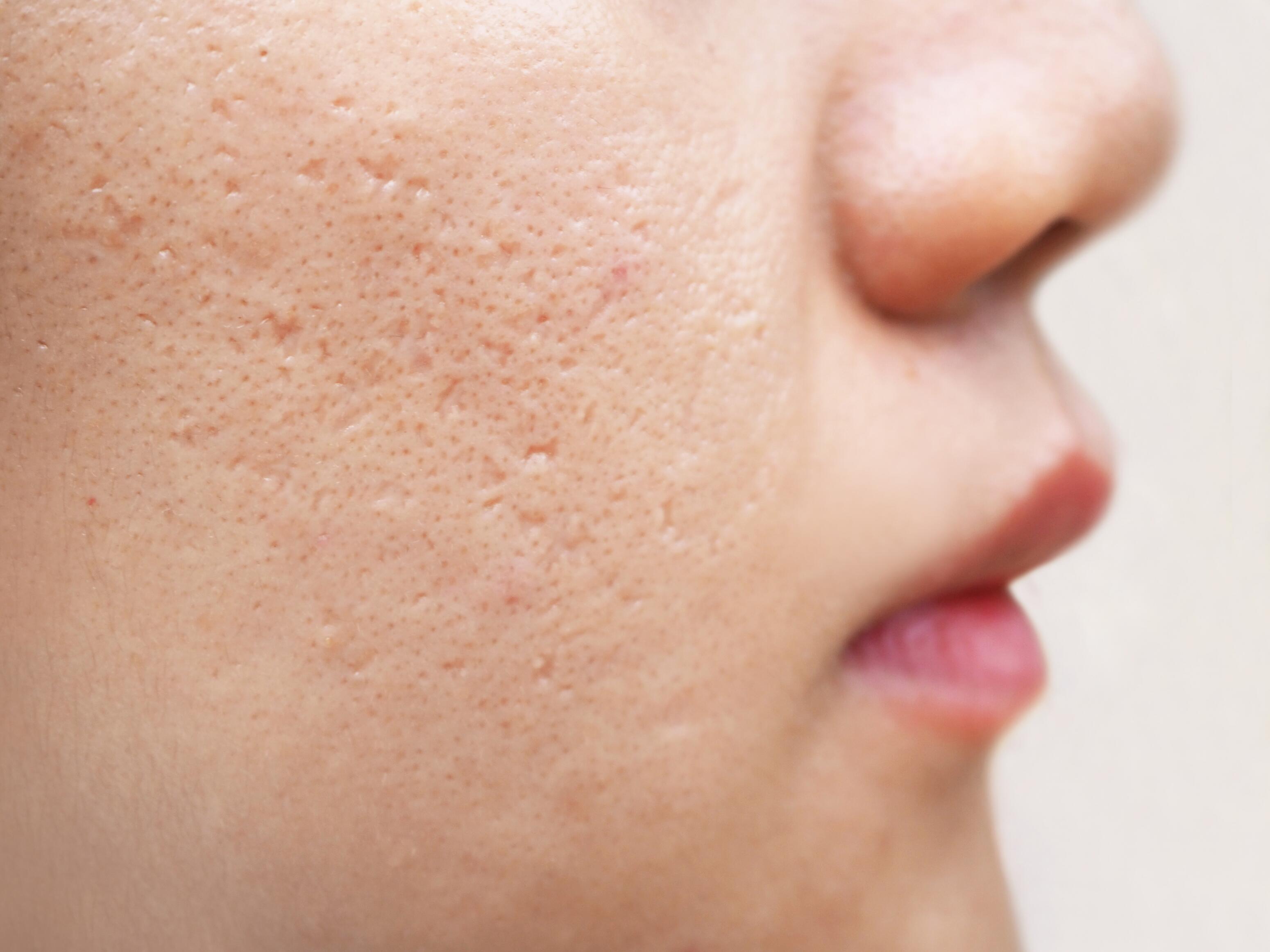 acne-ice-pik-scars-dexeryl