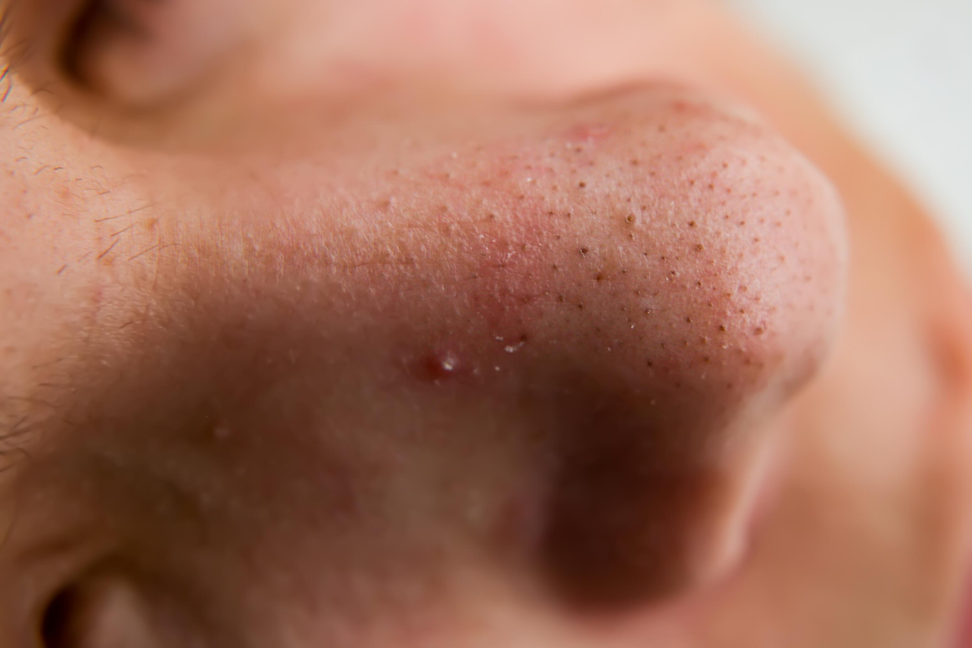 acne-visage-points-noirs-dexeryl