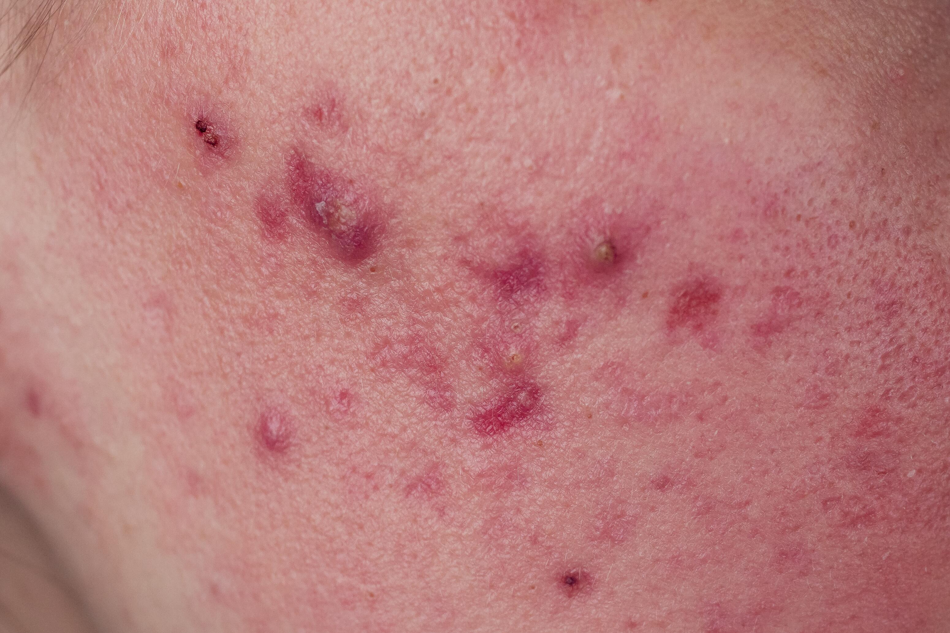 acne-visage-nodules-dexeryl