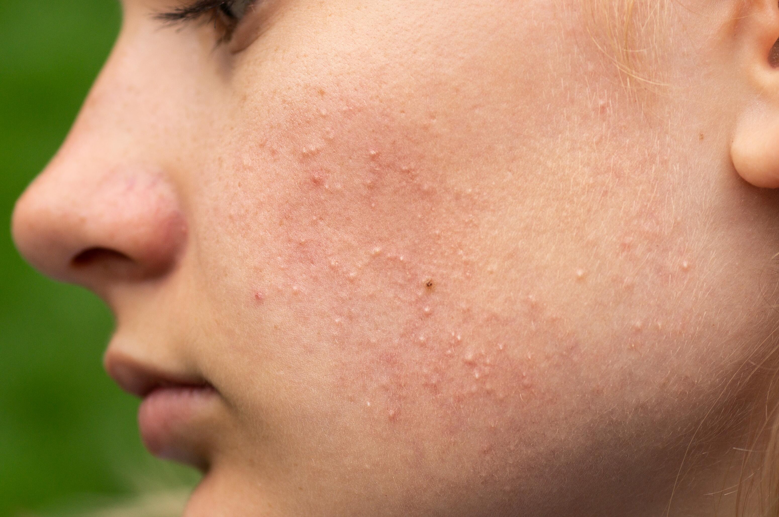 acne-visage-points-blancs-dexeryl