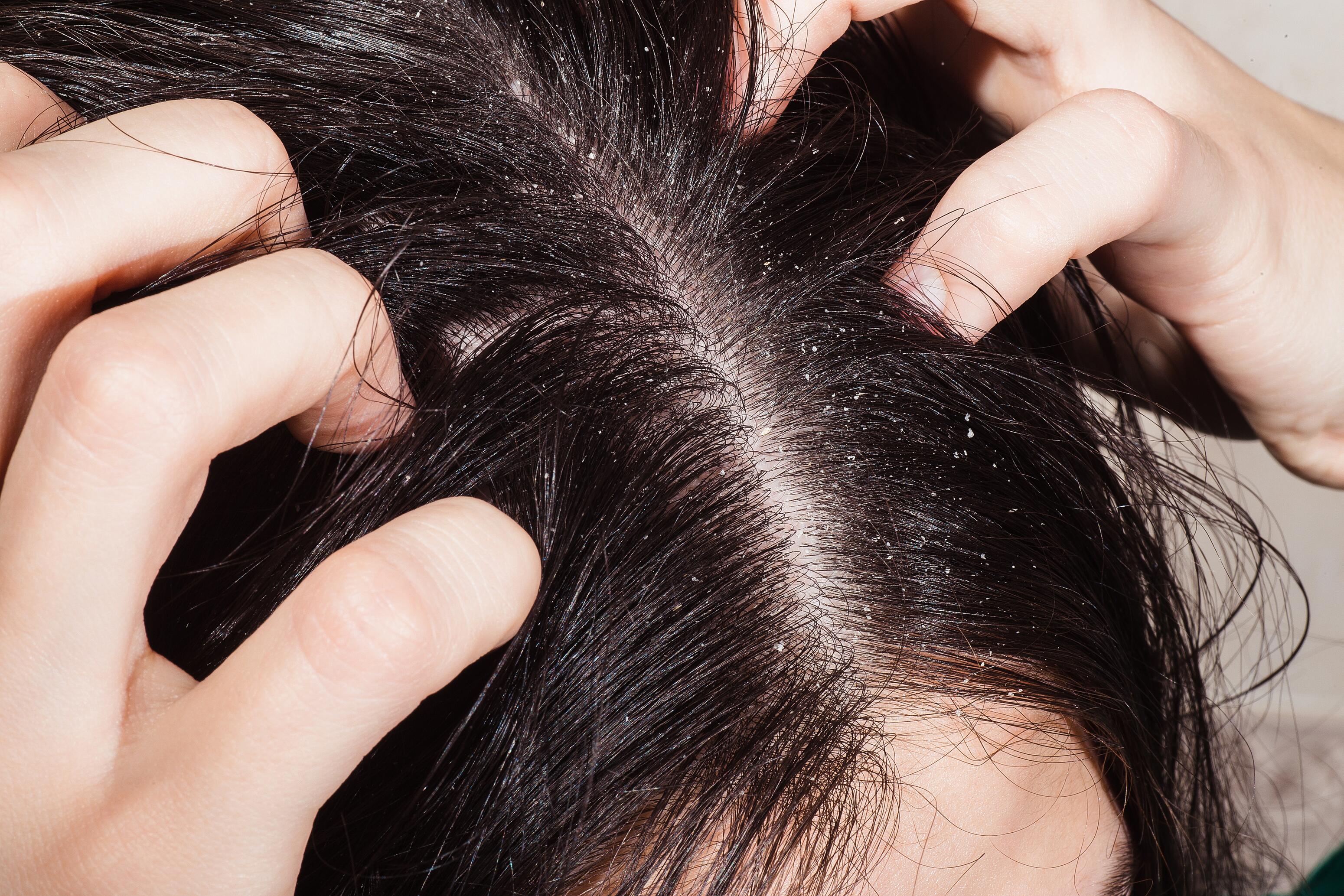 du_article_dandruff-sensitive-hair-scalp_header
