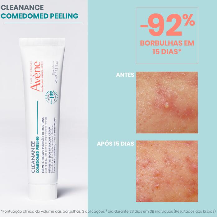 Resultados COMEDOMED PEELING Creme Intensivo para Surtos de Borbulhas