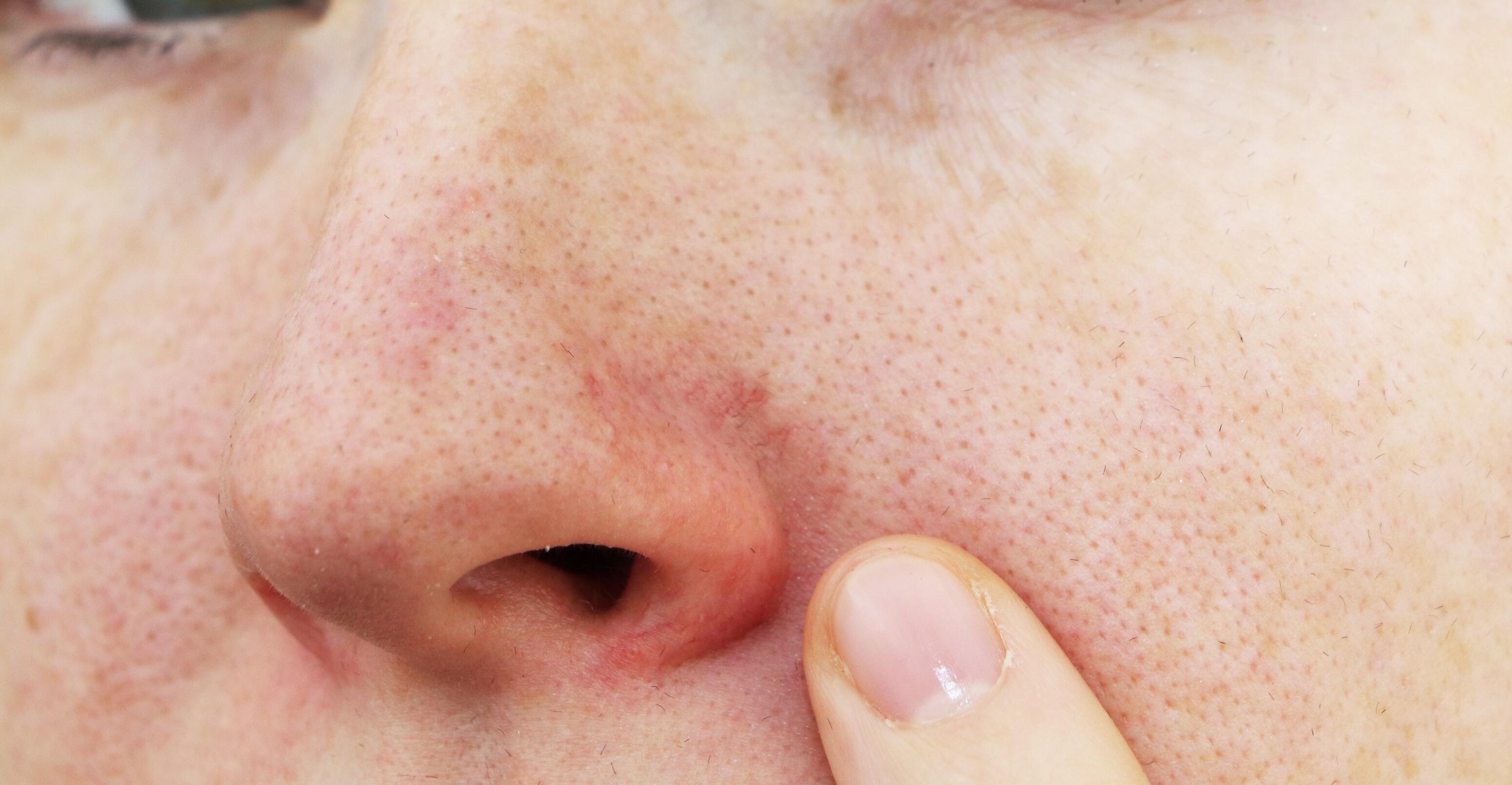 croûte dans le nez cigarette électronique Cancer du nez : pourquoi les vapoteurs seraient plus touchés que les fumeurs  ?