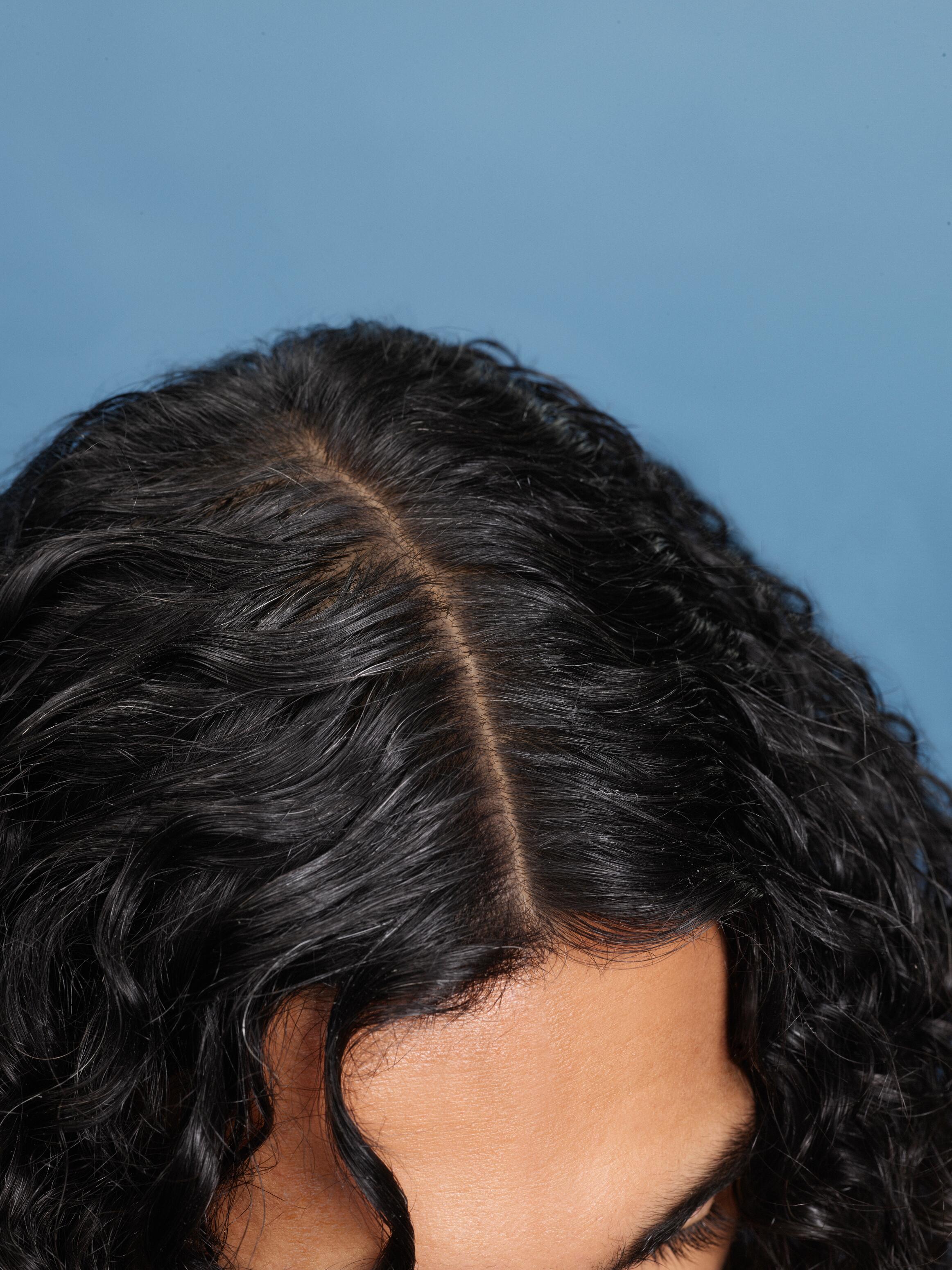 DU_KELUAL-DS_DS_SILO_L1_SEBORRHEIC-DERMATITIS-SCALP-AND-HAIR-LOSS