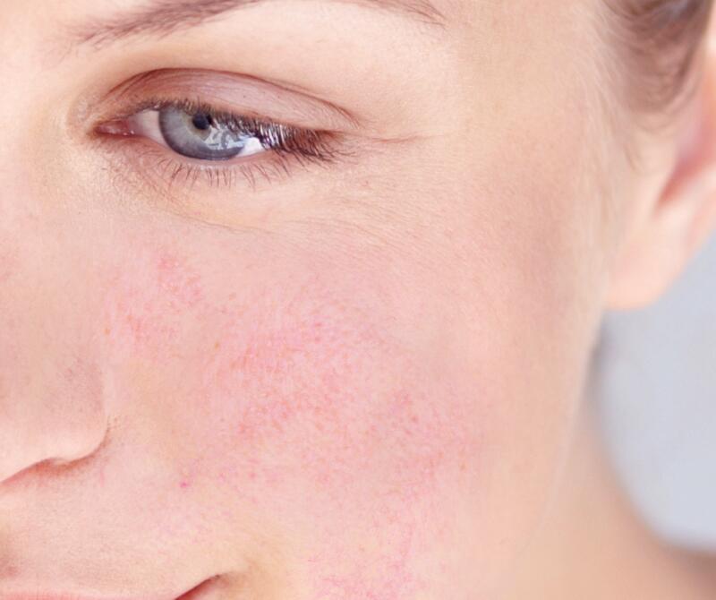 Get rid of redness on your face. Today and tomorrow.